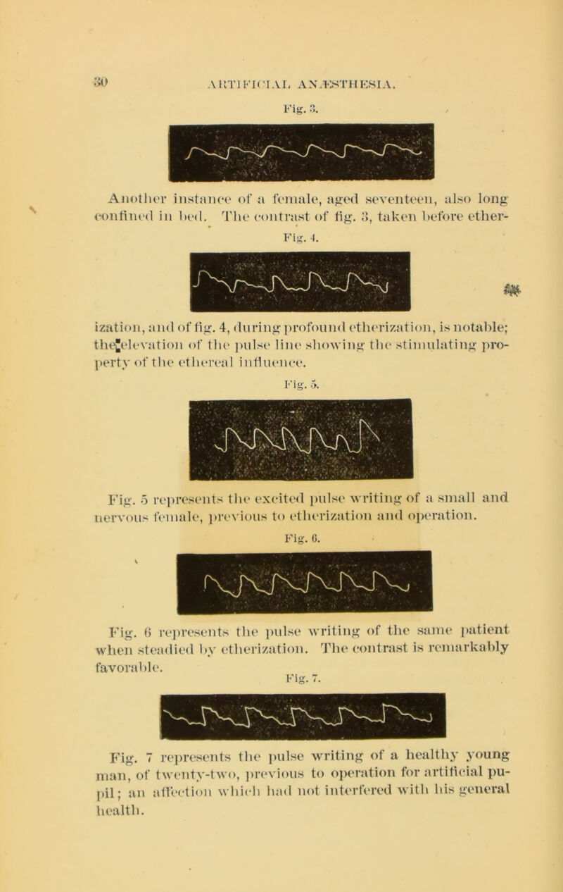 A KTl FI( I AI< AN.KSTH KKI A. Fig. r> »>• Another instance of ii female, ajjed seventeen, also long eontined in bed. The contrast of tig. .‘I, taken before ether- Fig. I. izutioii, and of tig. 4, during profouinl ('tlu'rization, is notable; tiu^elevation of the ])ulsi‘ liiu' showing the stimulating pro- pertyof the etlu'real inlluenee. Fig-. ■>. Fig. .5 rejwesents the excited pulse writing of a small and nervous female, i>revious to etherization and operation. Fig. 6. Fig. 0 represents the pidse writing of the same patient when steadied by etherization. The contrast is remarkably favorable. Fig. 7 re])resents the i)ulse writing of a healthy young man, of twt'iity-two, ])revious to operation for artilicial pu- pil; an atfection which liad not interfered with his general health.