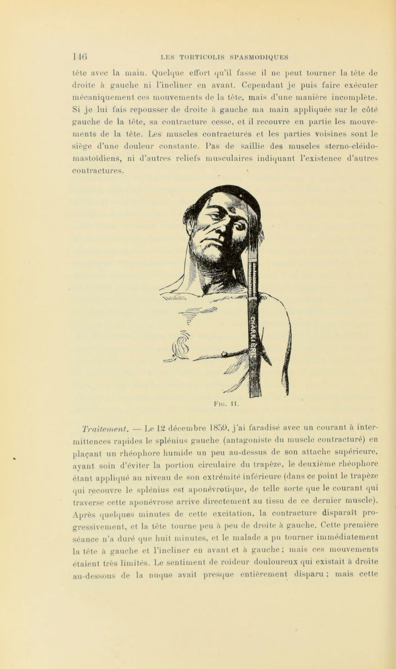 tète avec la iiiain. (^uel(|ue ellort (ju’il fasse il ne i)eut tourner la tète de droite à gauche ni l’incliner en avant. Ce[uuidanl je puis faire exécuter mécaniquement ces mouvements do la tète, mais d’une manière incomplète. Si je lui fais repousser de droite à gauche ma main ai)pliquée sur le côté gauche de la tète, sa contracture cesse, et il recouvre (mi })artie les mouve- ments de la tète. Lt's muscles contracturés et les })arties voisines sont le siège d’une douleur constante. Pas de saillie des muscles sterno-cléido- mastoïdiens, ni d’autres reliefs musculaires indi(juant l’existence d’autia^s contractures. Vu;. 11. Traitement. — Le décemhrc 18.7.). j’ai faradi.sé avec un courant ii inter- mittences rapides le splénius gauche (an(agonist<‘ du muscle contracturé) en plaçant un rhéophore humide un peu au-d(‘.ssus de son attache supérieure, avant soin d’éviter la portion circulaire du tra})èze, le (hmxième rhéophore étant appli(iué au niveau de son extrémité inh-rieuia* (dans ce point le trapèze qui recouvre le splénius <‘,st ai)onévroti(pie, d(‘ telle sorte (pie le courant (jui traverse cette ai)onévrose arrive directement au tissu de ce dernier muscle), .\l)rès (piehpies minutes de cette, excitation, la contracture disparaît pro- gressivement, et la tète tourne juni à peu de droite ;i gauche. Cett(* première séance n’a duré (ju(î huit minutes, (;t le malade a i)u tourner immédiatement la tète à gauche et l’incliner en avant et h gauche; mais ces mouvements étaient très limités. Le semtiment de roideur douloureux ([ui existait à droite au-de.ssous de la nmpio avait ])res(pie entièiauncnt disparu ; mais celte