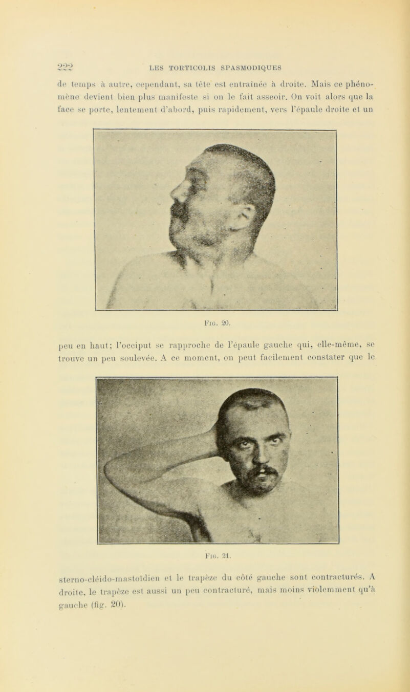 (1(* (eiiips ;i auli'c, cependant, sa tête est eiitraînée ;'i droite. Mais ce phéno- luèae devient bien plus manifeste si on le fait asseoir. On voit alors que la face se i>orte, lenleinont d’abord, puis rapidement, vers ré])aule droite et un Fig. 20. l)cu en haut; l’occiput se rapproche de l’épaule gauche qui, elle-même, se trouve un peu soulevée. A ce moment, on peut facilement constater que le sterno-cléido-mastoïdien et h* trapè/,(î du côté gauche sont contracturés. A droite, le traj)èzc est aussi un peu (îontracturé, mais moins violemment (|u’;i gauche (hg.