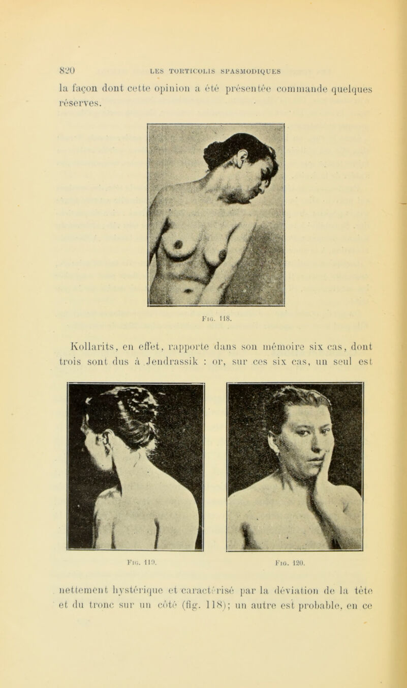 Kic. 11!>. Fig. 120. iiottomoiit hystrrii|uo ot cai-ict;'risi'* jnir la (lôviatioii (1(‘ la tèto et (lu tronc sur un c(H('‘ (fig. IIS); un autre est probable, en ce LES TOETICOLIS SCASMODIQUES la facjoii dont cette opinion a ét(‘ pr(‘sent('‘e coinniande qnekpies réserves. Kollarits, en etï'et, rapporte dans son mémoire six cas, dont trois sont dns à Jendrassik : or, sur ces six cas, un seul est