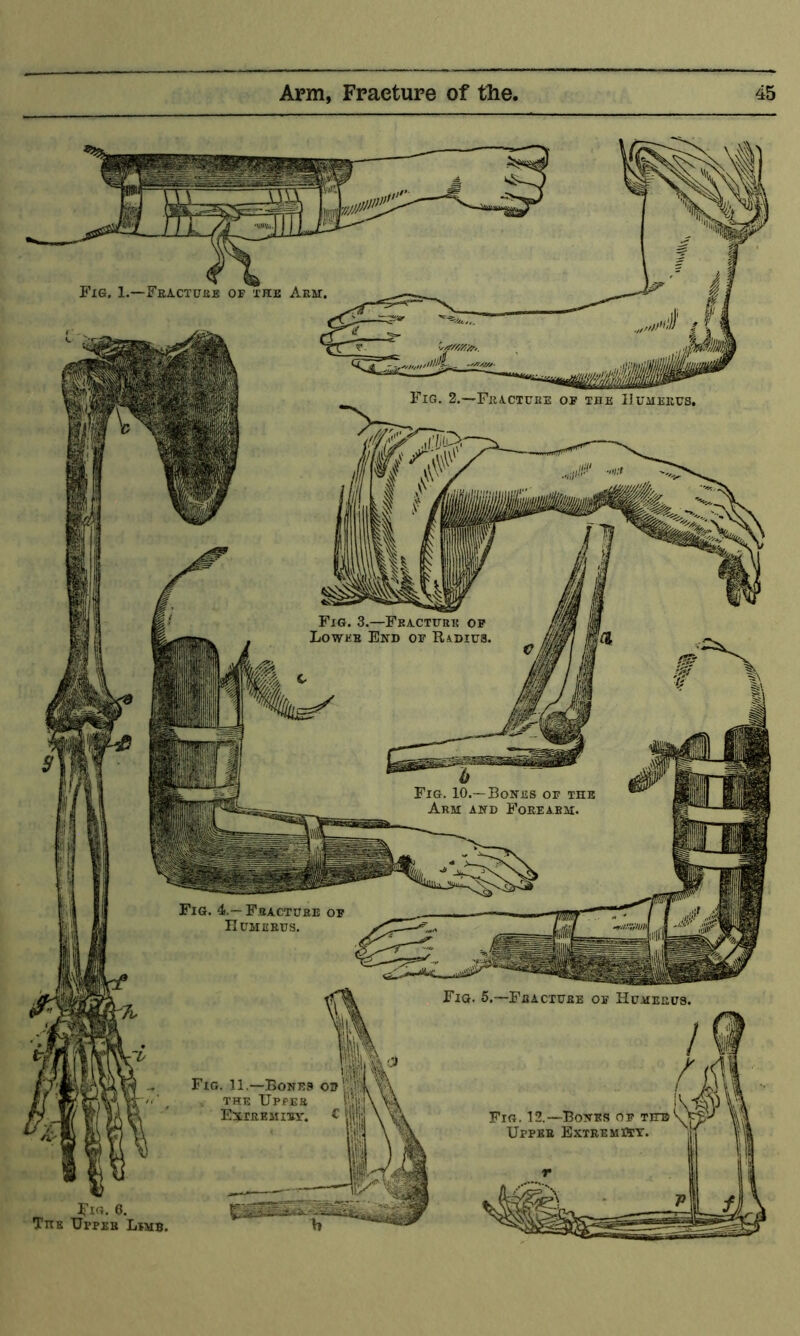 Fig. 1.—FEA.CTGJijE of the Arm. Fig. 2.—FiiiCTURE of the IJuiiekhs, Fig. 3.—Fracture of Lower End of Radius. Fig. 10.—Bones of the Arm and Forearm. Fig. 4.— Fracture IIUMEEUS. Fig. 5.—Feacture of Humerus. Fig. 11.—Bones od THE Upper Exirkmirv. C Fig. 12.—Bones of the Upper Extremist. Fig. 6. Titk Upper Limb.