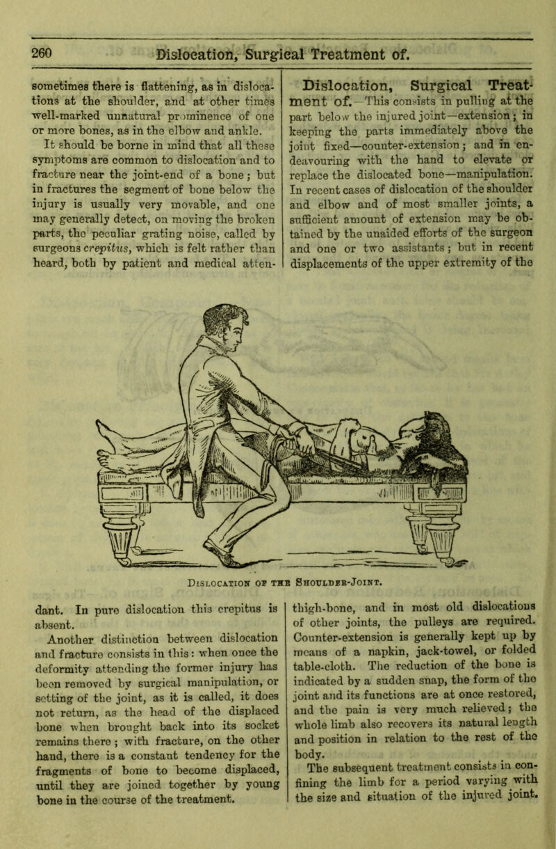 sometimes there is flattening, as in disloca- tions at the shonider, and at other times ■well-marked unnatural prominence of one or more bones, as in the elbo'sv and ankle. It should be borne in mind that all these symptoms are common to dislocation and to fracture near the joint-end of a bone; but in fractures the segment of bone belo'w the injury is usually very movable, and one may generally detect, on m.oving the broken parts, the peculiar grating noise, called by surgeons crepitus, -wlrich is felt rather than heard, both by patient and medical atten- Dislocation, Surgical Treat- ment of.—This coufiists in pulling at the part below the injured joint—extension; in keeping the parts immediately above the joint fixed—counter-extension; and in en- deavouring with the hand to elevate or replace the dislocated bone—manipulation. In recent cases of dislocation of the shoulder and elbow and of most smaller joints, a sufiBcient amount of extension may be ob- tained by the unaided efforts of the surgeon and one or two assistants; but in recent displacements of the upper extremity of the Dislocation op the Shouldeb-Joint. dant. In pure dislocation this crepitus is absent. Another distinction between dislocation and fracture consists in this: when once the deformity attending the former injury has been removed by surgical manipulation, or setting of the joint, as it is called, it does not return, as the head of the displaced bone ■fthen brought back into its socket remains there ; with fracture, on the other hand, there is a constant tendency for the fragments of bone to become displaced, until they are joined together by young bone in the course of the treatment. thigh-bone, and in most old dislocations of other joints, the pulleys are required. Counter-extension is generally kept up by means of a napkin, jack-towel, or folded table-cloth. The reduction of the bone is indicated by a sudden snap, the form of tho joint and its functions are at once restored, and the pain is very much relieved; the whole limb also recovers its natural length and position in relation to the rest of tho body. The subsequent treatment consists in con- fining the limb for a period varying -with the size and situation of tho injured joint.