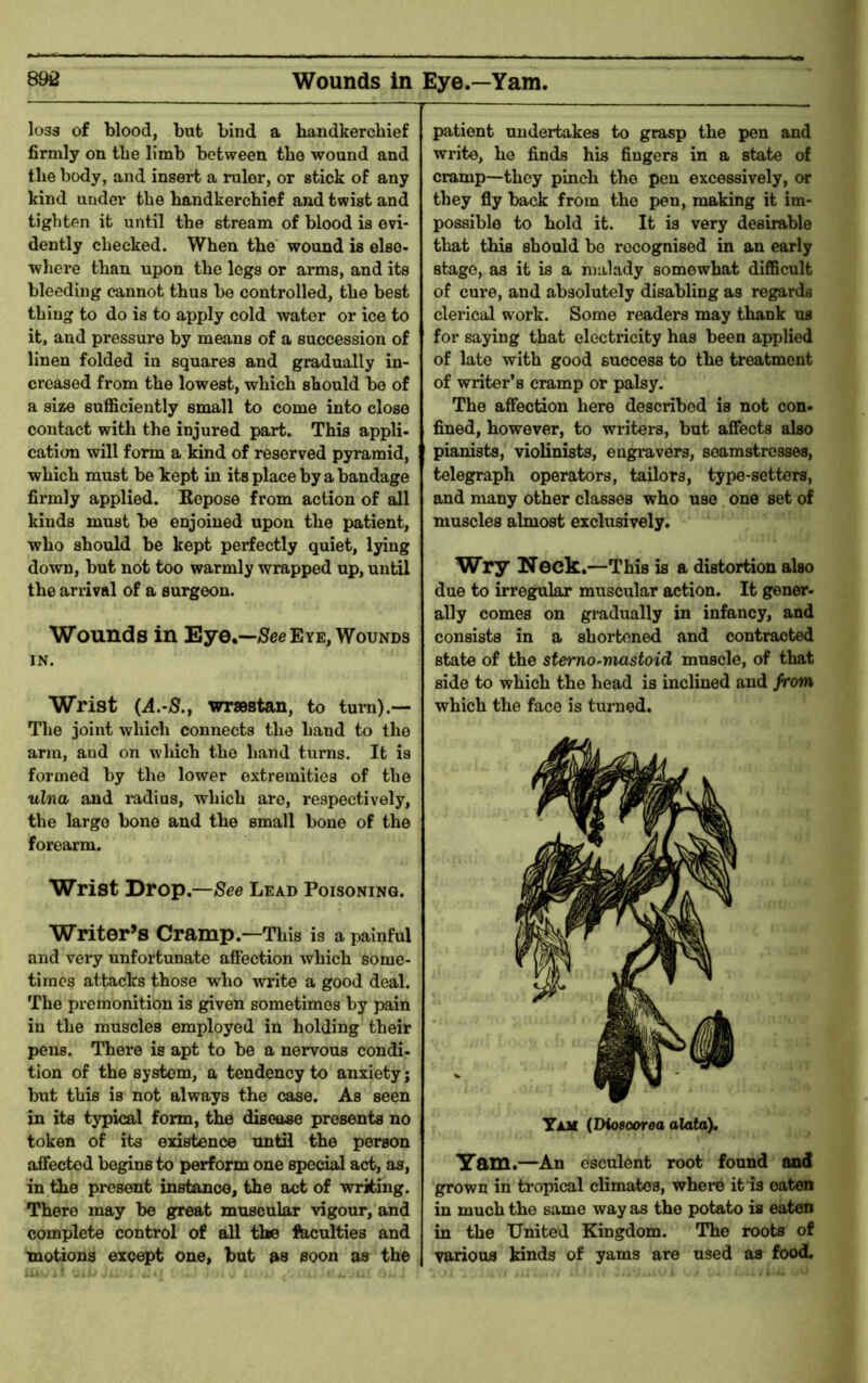 Wounds in Eye.—Yam. loss of blood, but bind a handkerchief firmly on the limb between the wound and the body, and insert a ruler, or stick of any kind under the handkerchief and twist and tighten it until the stream of blood is evi- dently cheeked. When the wound is else- where than upon the logs or arms, and its bleeding cannot thus bo controlled, the best thing to do is to apply cold water or ice to it, and pressure by means of a succession of linen folded in squares and gradually in- creased from the lowest, which should be of a size suflSiciently small to come into close contact with the injured part. This appli- cation will form a kind of reserved pyramid, which must be kept in its place by a bandage firmly applied. Kepose from action of all kinds must be enjoined upon the patient, who should be kept perfectly quiet, lying down, but not too warmly wrapped up, until the arrival of a surgeon. Wounds in Eye.—iSee Eye, Wounds IN. Wrist wr»stan, to turn).— The joint which connects the hand to the arm, and on which the hand turns. It is formed by the lower extremities of the ulna and i-adius, which are, respectively, the largo bone and the small bone of the forearm. Wrist Drop.—See Lead Poisoning. Writer’s Cramp.—This is a painful and very unfortunate affection which some- times attacks those who write a good deal. The premonition is given sometimes by pain in the muscles employed in holding their pens. Thei*e is apt to be a nervous condi- tion of the system, a tendency to anxiety; but this is not always the case. As seen in its typical form, the disease presents no token of its existence until the person affected begins to perform one special act, as, in the present instance, the act of writing. There may be great muscular vigour, and complete control of all the feculties and motions except one, but as soon as the patient undertakes to grasp the pen and write, he finds his fingers in a state of cramp—they pinch the pen excessively, or they fly back from the pen, making it im- possible to hold it. It is very desirable that this should be recognised in an early stage, as it is a malady somewhat difficult of cure, and absolutely disabling as regards clerical work. Some readers may thank us for saying that electricity has been applied of late with good success to the treatment of writer’s cramp or palsy. The affection here described is not con- fined, however, to writers, but afiects also pianists, violinists, engravers, seamstresses, telegraph operators, tailors, type-setters, and many other classes who use one set of muscles almost exclusively. Wry Neck.—This is a distortion also due to irregular muscular action. It gener- ally comes on gradually in infancy, and consists in a shortened and contracted state of the sterno-mastoid muscle, of that side to which the head is inclined and from which the face is turned. Yam (Diosoorea alata). 3rQ>m.—An esculent root found and grown in tropical climates, where it is oaten in much the same way as the potato is eaten in the United Kingdom. The roots of various kinds of yams are used as food.