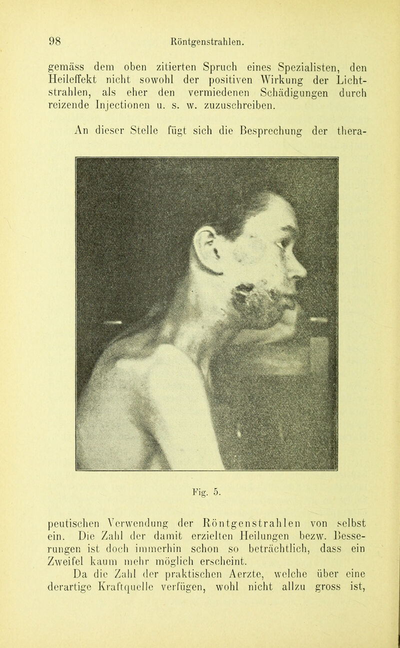 gemäss dem oben zitierten Spruch eines Spezialisten, den HeilefFekt nicht sowohl der positiven Wirkung der Licht- strahlen, als eher den vermiedenen Schädigungen durch reizende Injectionen u. s. w. zuzuschreiben. An dieser Stelle fügt sich die Besprechung der thera- Fig. 5. peutischen Verwendung der Röntgenstrahlen von selbst ein. Die Zahl der damit erzielten Heilungen bezw. Besse- rungen ist doch immerhin schon so beträchtlich, dass ein Zweifel kaum mehr möglich erscheint. Da die Zahl der praktischen Aerzte, welche über eine derartige Kraftquelle verfügen, wohl nicht allzu gross ist,