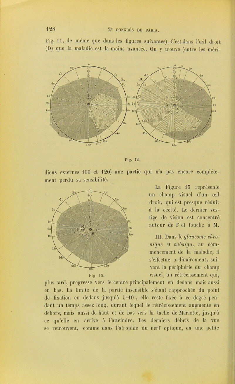 Fig. 11, de même que dans les figures suivantes). C’est dans l’œil droit (D) que la maladie est la moins avancée. On y trouve (entre les méri- ï8o Fig. 12. diens externes 100 et 120) une partie qui n’a pas encore complète- ment perdu sa sensibilité. III. Dans \e glaucome chro- nique et subaigu, au com- mencement de la maladie, il s’effectue ordinairement, sui- vant la périphérie du champ Fig. 13. visuel, un rétrécissement qui, plus tard, progresse vers le centre principalement en dedans mais aussi en bas. La limite de la partie insensible s’étant rapprochée du point de fixation en dedans jusqu’à 5-10, elle reste fixée à ce degré pen- dant un temps assez long, durant lequel le rétrécissement augmente en dehors, mais aussi de haut et de bas vers la tache de Mariotte, jusqu’à ce qu’elle en arrive à l’atteindre. Les derniers débris de la vue se retrouvent, comme dans l’atrophie du nerf optique, en une petite La Figure 15 représente un champ visuel d’un œil droit, qui est presque réduit à la cécité. Le dernier ves- tige de vision est concentré autour de F et louche à M.