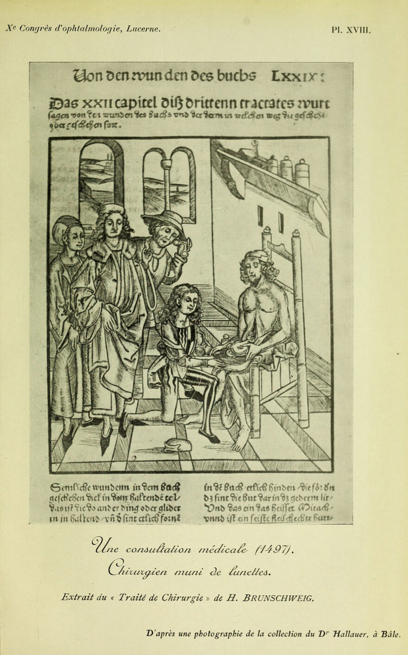 Ubn den mm den Des bucbs Lxxir: ©as xxn capicel 0ÎÇ örurenn tractates mirt wwibm %cs Sucßs>vn&<&cc<kxrH\n trcfdioi ncfctfcv Gemft'cfc mtnbcmt intern $&($ (n^c Qac9 etfieß ftmbm Sie f6*. tfrt $cf<tfdkn m&^ÇftPten&c tel/ geher m hr ^4Stf?^ic^oanhcr htÄf«hcr0lthcr *Vrtb 9s$ cm ÇcifJVt (îOira^ • Mi ni v ft $ fmt ctftcf fomf wib iß cm feiftc ft of <£t$u Jie co,nAuû<z/lan méchcti^ {1497). a 6IL C_ /nx/iii/f cn muni He /unelleA. Extrait du c Traité de Chirurgie » afe H. BRUNSCHWEIG. D’après une photographie de la collection du Dr Hallauer, à Bâle.