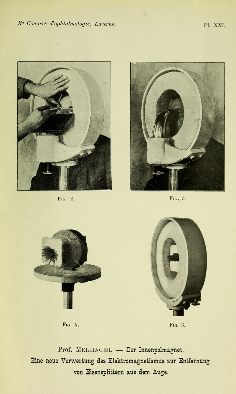 Fig. 2. Fig. 3. Fig. 4, Fig. o. Prof. Mellinger. — Der Innenpolmagnet. Eine neue Verwertung des Elektromagnetismus zur Entfernung von Eisensplittern aus dem Auge.
