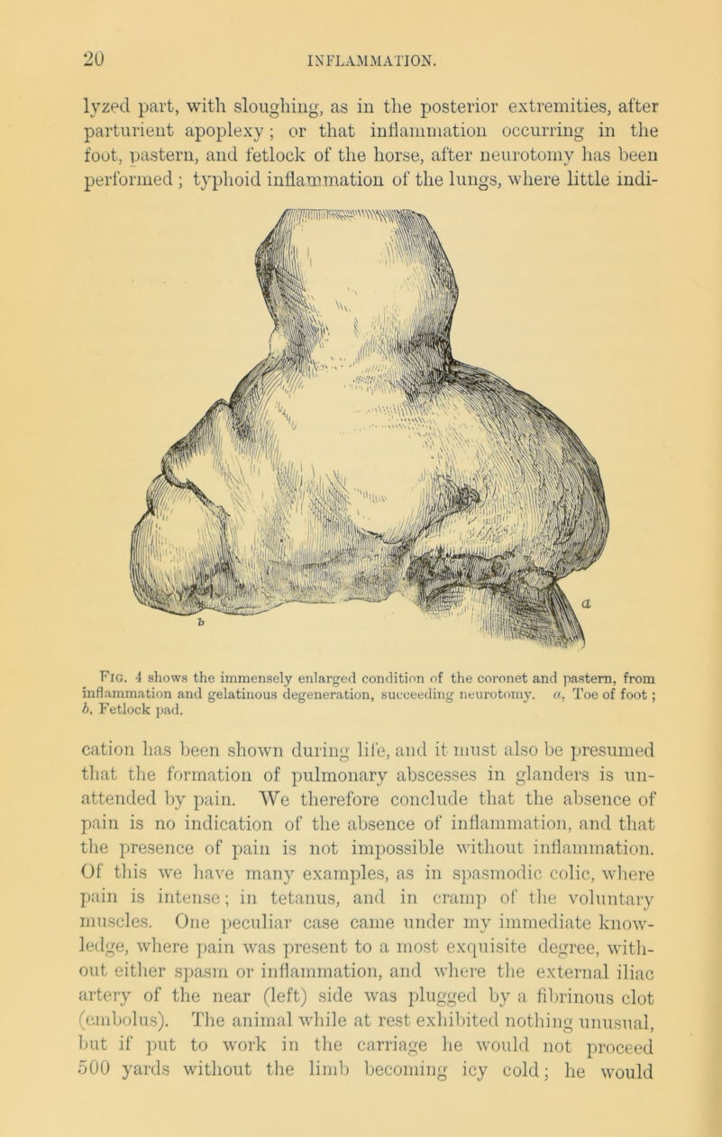 lyzed part, with sloughing, as in the posterior extremities, after parturient apoplexy; or that inflammation occurring in the foot, pastern, and fetlock of the horse, after neurotomy has been performed ; typhoid inflammation of the lungs, where little indi- Fig. 4 shows the immensely enlarged condition of the coronet and pastern, from inflammation and gelatinous degeneration, succeeding neurotomy, a. Toe of foot; b, Fetlock pad. cation lias been shown during life, and it must also be presumed that the formation of pulmonary abscesses in glanders is un- attended by pain. We therefore conclude that the absence of pain is no indication of the absence of inflammation, and that the presence of pain is not impossible without inflammation. Of this we have many examples, as in spasmodic colic, where pain is intense; in tetanus, and in cramp of the voluntary muscles. One peculiar case came under my immediate know- ledge, where pain was present to a most exquisite degree, with- out either spasm or inflammation, and where the external iliac artery of the near (left) side was plugged by a fibrinous clot (embolus). The animal while at rest exhibited nothing unusual, but if put to work in the carriage he would not proceed 500 yards without the limb becoming icy cold; he would