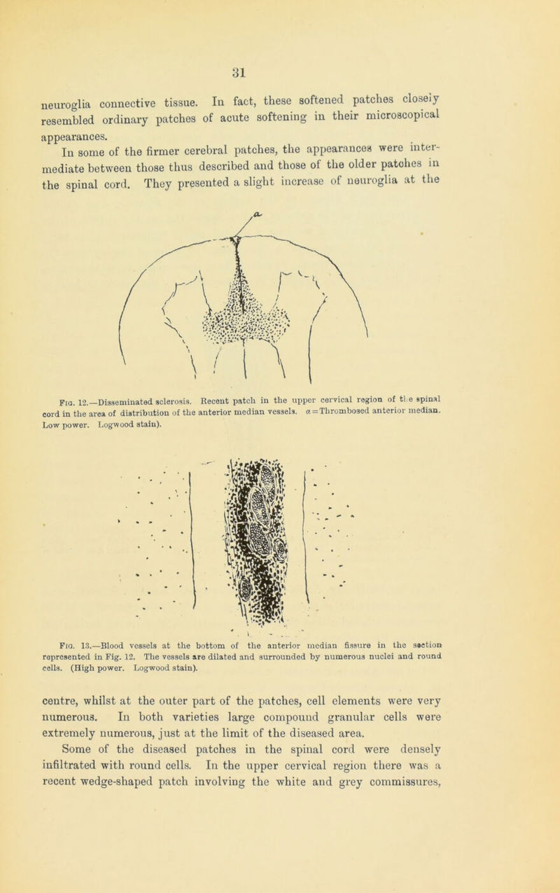 neuroglia connective tissue. In fact, these softened patches closeiy resembled ordinary patches of acute softening in their microscopical appearances. In some of the firmer cerebral patches, the appearances were inter- mediate between those thus described and those of the older patches in the spinal cord. They presented a slight increase of neuroglia at the Fig. 12.—Disseminated sclerosis. Recent patch in the upper cervical region of tie spinal cord in the area of distribution of the anterior median vessels, a = Thrombosed anterior median. Low power. Logwood stain). Fid. 13.—Blood vessels at the bottom of the anterior median fissure in the section represented in Fig. 12. The vessels are dilated and surrounded by numerous nuclei and round cells. (High power. Logwood stain). centre, whilst at the outer part of the patches, cell elements were very numerous. In both varieties large compound granular cells were extremely numerous, just at the limit of the diseased area. Some of the diseased patches in the spinal cord were densely infiltrated with round cells. In the upper cervical region there was a recent wedge-shaped patch involving the white and grey commissures,