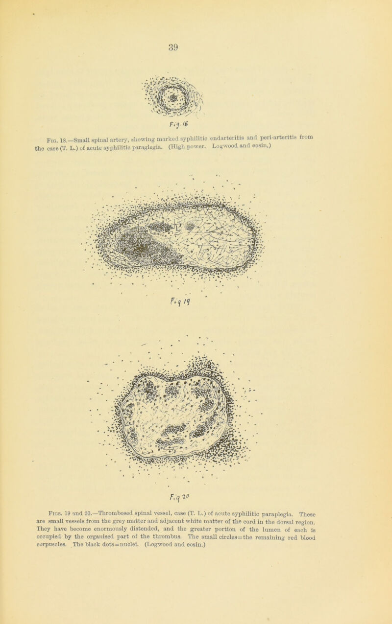 Fig. IS.—Small spinal artery, showing marked syphilitic endarteritis and peri-arteritis from the case (T. L.) of acute syphilitic paraglegia. (High power. Logwood and eosm.) Figs. 19 and 20.—Thrombosed spinal vessel, case (T. L.) of acute syphilitic paraplegia. These are small vessels from the grey matter and adjacent white matter of the cord in the dorsal region. They have become enormously distended, and the greater portion of the lumen of each is occupied by the organised part of the thrombus. The small circles = the remaining red blood corpuscles. The black dots = nuclei. (Logwood and eosin.)