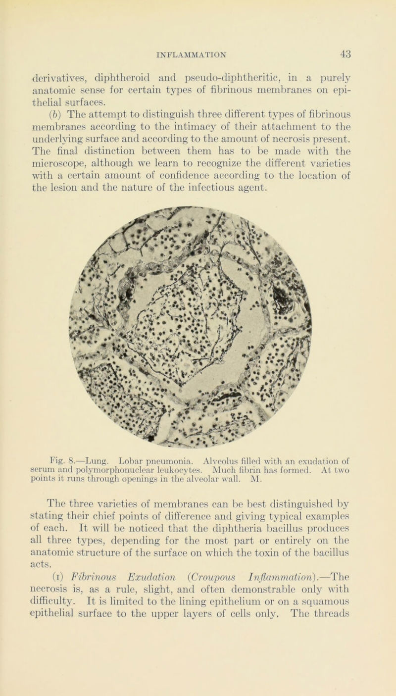 derivatives, diphtheroid anti iiseiido-diphtheritic, in a juirely anatomic sense for certain types of fibrinous meinliranes on epi- thelial surfaces. {b) The attemjit to distinguish three different types of fibrinous membranes according to the intimacy of their attachment to the underlying surface anti accortling to the amount of necrosis ]iresent. The final distinction lietween them has to be made with the microscope, although we learn to recognize the different varieties with a certain amount of confidence according to the location of the lesion and the nature of the infectious agent. Fig. S.—Lung. Lobar pneumonia. Alveolus filled with an exudation of serum and polymorphonuelear leukocytes. Much fibrin has formed. At two points it runs through openings in the alveolar wall. M. The three varieties of membranes can be best distinguished by stating their chief points of difference and giving ty]iical examples of each. It will be noticed that the diphtheria bacillus produces all three types, depending for the most jiart or entirely on the anatomic structure of the surface on which the toxin of the bacillus acts. (i) Fibrinous Exmlation (Croupous Inflammation).—The necrosis is, as a rule, slight, and often demonstrable only with difficulty. It is limited to the lining epithelium or on a squamous epithelial surface to the upper layers of cells only. The threads