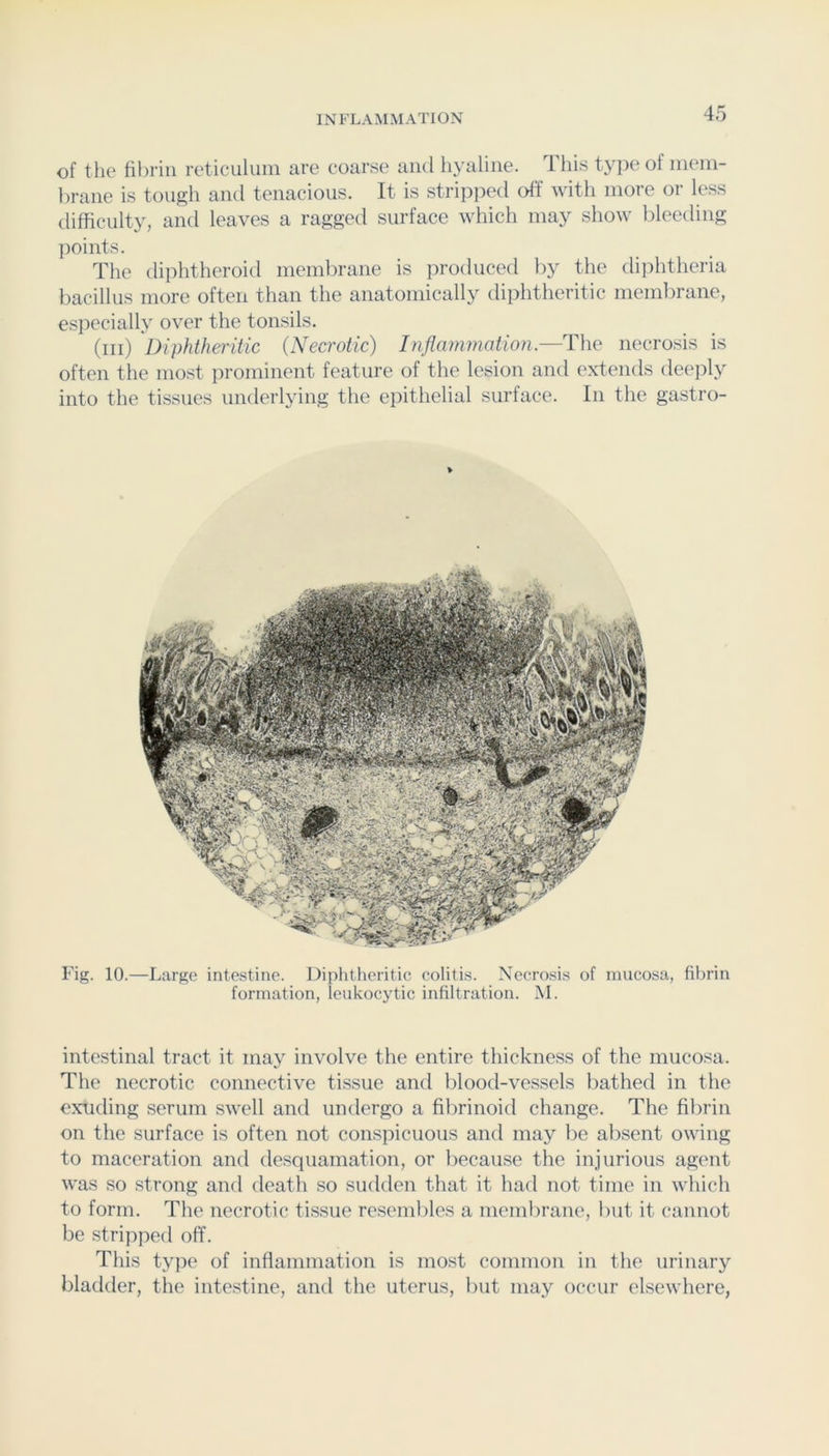 of the fibrin reticulum are coarse and hyaline. This tyjie of mem- brane is tough and tenacious. It is stripjied off with more or less difficulty, and leaves a ragged surface which may show bleetling ]ioints. The diphtheroid membrane is jiroduced by the diphtheria bacillus more often than the anatomically diphtheritic membrane, especially over the tonsils. (ill) Diphtheritic (Necrotic) Inflammation.—The necrosis is often the most prominent feature of the lesion and extends deejily into the tissues uiulerlying the epithelial surface. In the gastro- Fig. 10.—Large intestine. Diphtheritic colitis. Necrosis of mucosa, fibrin formation, leukocytic infiltration. AI. intestinal tract it may involve the entire thickness of the mucosa. The necrotic connective tissue and blood-vessels bathed in the exuding serum swell and undergo a fibrinoid change. The fibrin on the surface is often not conspicuous and may be absent owing to maceration and desquamation, or because the injurious agent was so .strong and death so sudden that it had not time in which to form. The necrotic ti.ssue resembles a membrane, but it cannot be stripped off. This type of inflammation is most common in the urinary bladder, the intestine, and the uterus, but may occur elsewhere,