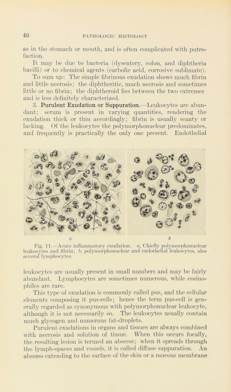 as in the stomach or moutli, ami is often comiilicated with putre- faction. It may be due to bacteria (dysentery, colon, and diphtheria bacilli) or to chemical agents (carbolic acid, corrosive sublimate). To sum up: The simiile fibrinous exudation shows much filirin and little necrosis; the diphtheritic, much necrosis and sometimes little or no fibrin; the diphtheroid lies between the two extremes and is less definitely characterized. 3. Purulent Exudation or Suppuration.—Leukocytes are abun- dant; serum is present in varying quantities, rendering the exudation thick or thin accordingly; fibrin is usually scanty or lacking. Of the leukocytes the polymorphonuclear predominates, and frequently is practically the only one present. Endothelial Fig. 11.—Acuto inflammatory exudation, a, Cliicfly polymoridionuclear leukocytes and fibrin; h, polymorphonuclear and endothelial leukocytes, also several lymphocytes. leukocytes are usually present in small numbers and may be fairly abundant. Lymphocytes are sometimes numerous, while eosino- philes are rare. This type of exudation is commonly called pus, and the cellular elements composing it pus-cells; hence the term pus-cell is gen- erally regarded as synonymous with polymorphonuclear leukocyte, although it is not necessarily so. The leukocytes usually contain much glycogen and numerous fat-droplets. Ihirulent exudations in organs and tissues are always combined with necrosis and solution of tissue. When this occurs focally, the resulting lesion is ternKnl an abscess; when it spreads through the lymph-spaces and vessels, it is called diffuse suppuration. An abscess extending to the surface of the skin or a mucous membrane