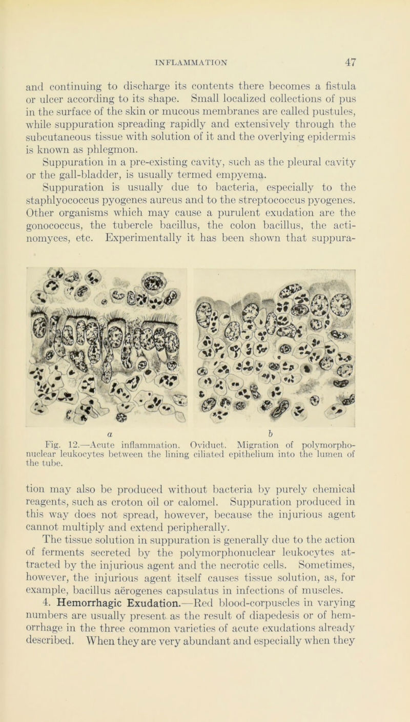 ami continuing to discharge its contents there lieconies a fistula or ulcer according to its shape. Small localized collections of pus in the surface of the skin or mucous membranes are called jmstules, while suppuration spreading rapidly and extensively through the subcutaneous tissue with solution of it and the overlying epidermis is known as phlegmon. Suppuration in a pre-existing cavity, such as the pleural cavity or the gall-bladder, is usually termed emiiyema. Suppuration is usually due to bacteria, especially to the staphlyococcus pyogenes aureus and to the streptococcus jiyogcnes. Other organisms which may cause a purulent exudation are the gonococcus, the tubercle bacillus, the colon bacillus, the acti- nomyces, etc. Experimentally it has been shown that suppura- a b 12.—Acute inflammation. Oviduct. Migration of polymorpho- nuclear leukocytes between the lining ciliated epithelium into the lumen of the tube. tion may also be produced without bacteria by jnirely chemical reagents, such as croton oil or calomel. Suiipuration jirodticed in this way does not spread, however, because the injurious agent cannot multiply and extend peripherally. The tissue solution in supiniration is generally due to the action of ferments secreted by the polymoriihonuclear leukocytes at- tracted by the injurious agent and the necrotic cells. Sometimes, however, the injurious agent itself causes tissue solution, as, for example, bacillus aerogenes capsulatus in infections of muscles. 4. Hemorrhagic Exudation.—Red blood-corpuscles in varying numbers are usually present as the result of diajiedesis or of hem- orrhage in the three common varieties of acute exudations already described. When they are very abundant and esiiecially when they