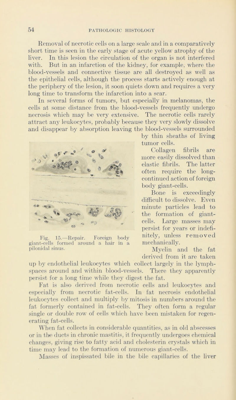 Reiiioval of necrotic cells on a large scale and in a comjiaratively short time is seen in the early stage of acute yellow atrophy of the liver. In this lesion the circulation of the organ is not interfered with. But in an infarction of the kidney, for example, where the blood-vessels and connective tissue are all destroyed as well as the epithelial cells, although the process starts activel}' enough at the peri]ihery of the lesion, it soon quiets down and requires a very long time to transform the infarction into a scar. In several forms of tumors, but especially in melanomas, the cells at some distance from the Iilood-vessels frequently undergo necrosis which may be very extensive. The necrotic cells rarely attract any leukocjdes, proliably because they very slowly dissolve and disa]i]3ear by al)SOi’]3tion leaving the blood-vessels surrounded b}^ thin sheaths of living tumor cells. Collagen fibrils are more easily dissolved than elastic filirils. The latter often require the long- continued action of foreign bod.y giant-cells. Bone is exceedingly difficult to dissolve. Even minute jiarticles lead to the formation of giant- cells. Large masses may persist for years or indefi- nitely, unless removed mechanically. Myelin and the fat derived from it are taken u]) by endothelial leukocytes which collect largely in the lymph- s]iaces around and within blood-vessels. There they ajiparently persist for a long time while they digest the fat. Fat is also derived from necrotic cells and leukocytes and espi'cially from necrotic fat-cells. In fat necrosis endothelial leukocytes collect and multiply by mitosis in numbers around the fat formerly contained in fat-cells. They often form a regular single or double row of cells which have lieen mistaken for regen- erating fat-cells. Wdien fat collects in consideralile quantities, as in old abscesses or in the ducts in chronic mastitis, it frefiuently undergoes chemical cfianges, giving rise to fatty acid and cholesterin crystals which in time may lead to the formation of nuuKTous giant-cells. Masses of inspissated bile in the bile capillaries of the liver 4 & •V *5® ■ p C?) Fig. 1.5.—Repair. Foreign body giant-cells form('d around a hair in a pilonidal sinus.