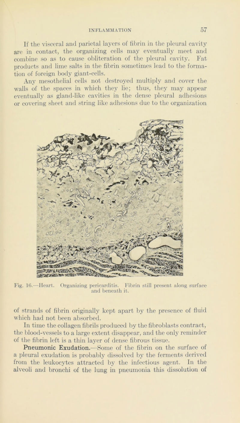 If the visceral and parietal layers of fibrin in the pleural cavity ai’C in contact, the organizing cells may eventually meet and combine so as to cause obliteration of the jileural cavity. Fat jiroducts and lime salts in the fibrin sometimes lead to the forma- tion of foreign body giant-cells. Any mesothelial cells not destroyed multi])ly and cover the walls of the spaces in M'hich they lie; thus, they may apjjear eventually as gland-like cavities in the dense jileural adhesions or covering sheet and string like adhesions due to the organization Fig. 1().—Heart. Organizing pcricarditi.s. Fibrin still present along surface and beneath it. of strands of filirin originally kept apart by the presence of fluid which had not been absorbed. In time the collagen fibrils produced by the fibroblasts contract, the blood-vessels to a large extent disappear, and the only reminder of the filtrin left is a thin layer of dense fibrous tissue. Pneumonic Exudation.—Some of the filirin on the surface of a pleural exudation is probably dissolved by the ferments derived from the leukocytes attracted by the infectious agent. In the alveoli and bronchi of the lung in pneumonia this dissolution of