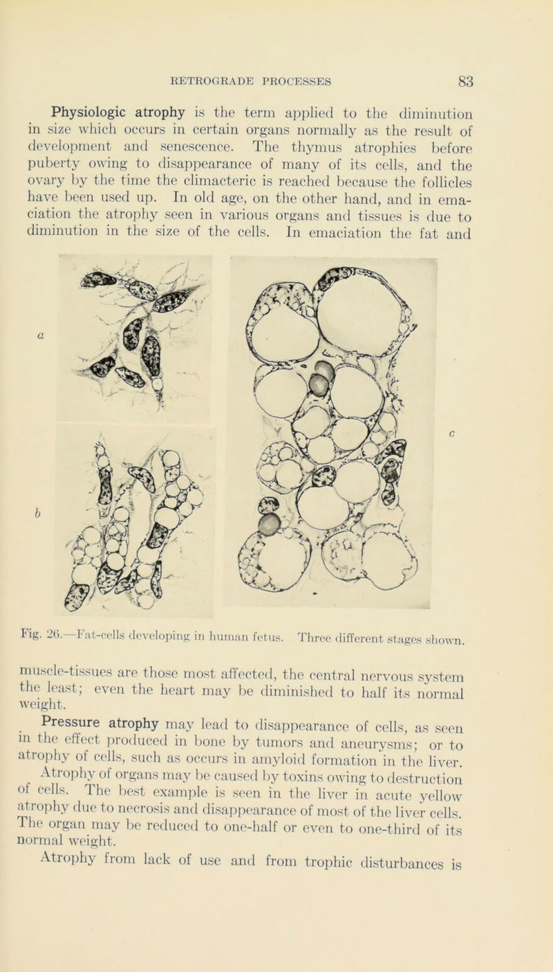 Physiologic atrophy is the term applied to tlie diminution in size which occurs in certain organs normally as the result of development and senescence. The th3unus atrophies before puberty owing to disappearance of many of its cells, and the ovary by the time the climacteric is reached because the follicles have been used up. In old age, on the other hand, and in ema- ciation the atrophy seen in various organs and ti.ssues is due to diminution in the size of the cells. In emaciation the fat and Fig. 2().—Fat-cells developing in human fet us. Three different stages shown. muscle tissues are those most affected, the central nervous S3^stem the least; even the heart nia3^ diminished to half its normal weight. Pressure atrophy ma3 lead to disappearance of cells, as seen in the effect produced in bone by tumors and aneur3'sms; or to atrophy of cells, such as occurs in amyloid formation in the liver. Atrophy of organs ma3^ be caused by toxins owing to destruction of cells. The best example is seen in the liver in acute yellow atrophy due to necrosis and disaj)]X'arance of most of the liver cells. The organ inay be reduced to one-half or even to one-third of its normal weight. Atrophy from lack of use and from trophic disturbances is