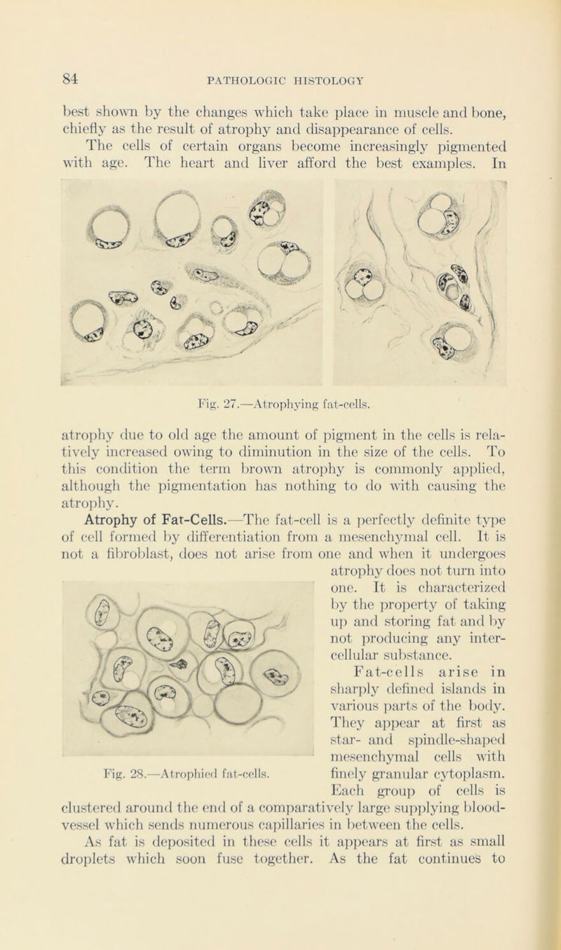 best shown by the changes whicli take })lace in muscle and bone, chiefly as the result of atrophy and disappearance of cells. The cells of certain organs become increasingly ]:>igmented with age. The heart and liver afford the best examjiles. In / W 4: N .^-.r Fi”;. 27.—Atrophyinfj; fat-oolls. atro))hy due to old age the amount of pigment in the cells is rela- tively increased owing to diminution in the size of the cells. To this condition the term bromi atrojihy is commonly applied, although the pigmentation has nothing to do with causing the atro])hy. Atrophy of Fat-Cells.—The fat-cell is a iierfectly definite type of cell formed by differiaitiation from a mesenchymal cell. It is not a fibroblast, does not arise from one and when it undergoes atrophy does not turn into one. It is characterized by the pro])erty of taking u]) and storing fat and l)y not jiroducing any inter- cellular substance. Fat-cells arise in sharply defined islands in various parts of the l)ody. Tliey ap]iear at first as star- and spindle-shaped mesenchymal cells with fiiK'ly granular cytoplasm. Each gTouji of cells is clustered around the end of a comparatively large sipijilying blood- vessel which sends numerous capillaries in lietween the cells. As fat is deposited in these cells it ajipi'ars at first as small droplets which soon fuse together. As the fat continues to Fig. 28.—Atropliiod fat-celLs.