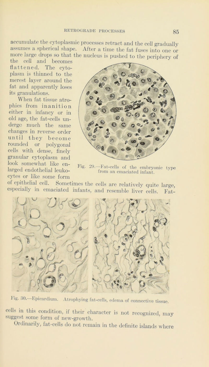 accumulate the cytoplasmic processes retract and the cell gradually assumes a spheiical shape. Alter a time the fat fuses into one or moie laige drops so that the nucleus is pushed to the perij)hery of the cell and becomes flattened. The cyto- plasm is thinned to the merest layer around the fat anti apparently loses its granulations. AMien fat tissue atro- phies from inanition either in infancy or in old age, the fat-cells un- dergo much the same changes in reverse order until they become roundetl or polygonal cells with dense, finely granular cytoplasm and look somewhat like en- larged endothelial leuko- cytes or like some form of epithelial cell. Sometimes the cells are relatively quite large, especially in emaciated infants, and resemlde liver cells. Fat- ing. 29. rat-(!ells of the emliryonic from an emaciated infant. type cells m this condition, if their character is not recognized, may suggest some form of new-growth. Oidinaiily, fat-cells do not remain in the tlefinite islands where