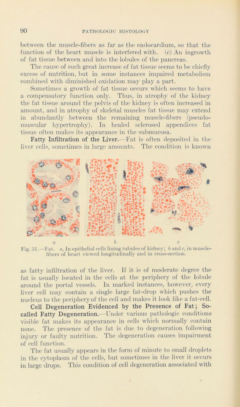 between the muscle-fibers as far as the endocardium, so that the function of the heart muscle is interfered with, (c) An ingroYdh of fat tissue between anti into the lobules of the pancreas. The cause of such great increase of fat tissue seems to be chiefly excess of nutrition, but in some instances impaired metaliolism combined with diminished oxidation may play a part. Sometimes a gTo^^i;h of fat tissue occurs which seems to have a compensatory function only. Thus, in atrojihy of the kidney the fat tissue around the pelvis of the kidney is often increased in amount, and in atrophy of skeletal muscles fat tissue may extend in abundantly between the remaining muscle-fibers (pseudo- muscular hypertroiihy). In healed sclerosed appendices fat tissue often makes its a]ipearance in the submucosa. Fatty Infiltration of the Liver.—Fat is often deposited in the liver cells, sometimes in large amounts. The condition is known 3 •’in !ri. ^ ♦ :vV a b c Fig. 31.—Fat. a, In epitliolial colls lining tubnles of kidney; h and c, in nuiscle- fibers of heart viewed longitu(linally and in cro.s.s-section. as fatty infiltration of the liver. If it is of moderate degree the fat is usually located in the cells at the iierijihery of the lobule around the portal vessels. In marked instances, however, every liver cell may contain a single large fat-droj) which ]iushes the nucleus to the periphery of the cell and makes it look like a fat-cell. Cell Degeneration Evidenced by the Presence of Fat; So- called Fatty Degeneration.—Under various j:)athologic conditions visible fat makes its appearance in cells which normally contain none. The presence of the fat is due to degeneration following injury or faulty nutrition. The degeneration causes im])aimient of cell function. The fat usually appears in the form of minute to small drojilets in the cytoplasm of the cells, Init sometimes in the liver it occurs in large drops. This condition of cell degeneration associated with