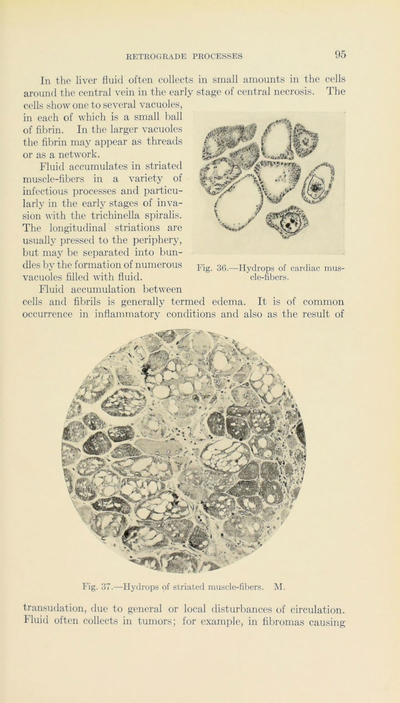 In the liver fluid often collects in small amounts in the cells around the central vein in the early stage of central necrosis. The cells show one to several vacuoles, in each of Avhich is a small ball of fibrin. In the larger vacuoles the fibrin may appear as threads or as a netAvork. Fluid accumulates in striated muscle-fibers in a variety of infectious processes and particu- larly in the early stages of inva- sion Avith the trichinella spiralis. The longitudinal striations are usually pressed to the periphery, but may be separated into bun- dles b}' the formation of numerous vacuoles filled AA'ith fluid. Fluid accumulation betAA'een cells and fibrils is generally termed edema. It is of common occurrence in inflammatory conditions and also as the result of Fig. 37.—Ilydrop.s of striated mu.scle-fibers. M. transudation, due to general or local disturbances of circulation. Fluid often collects in tumors; for example, in fibromas causing Fig. 3G.—Hydrops of cardiac mus- cle-fibers.