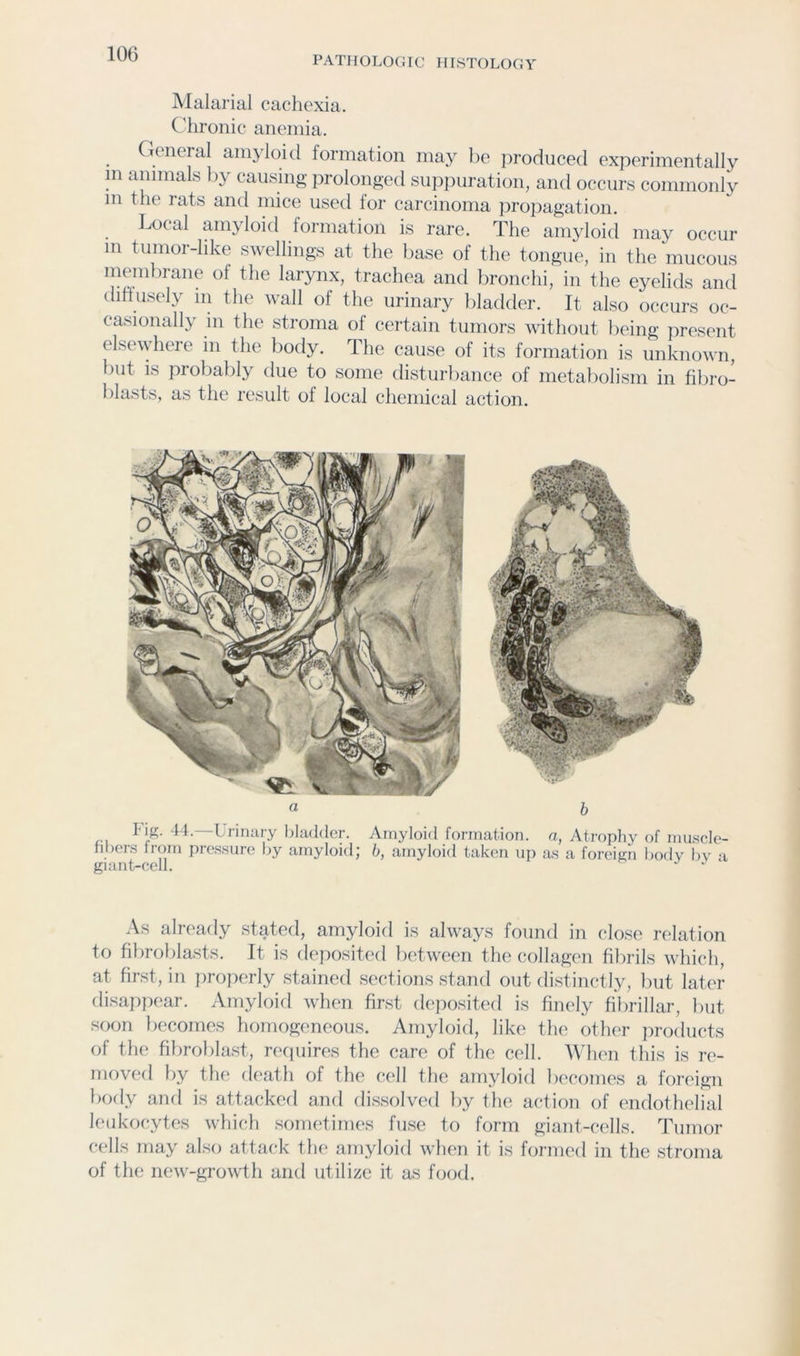 PATHOLOGIC HISTOLOGY Malarial cachexia. Chronic anemia. General amyloid formation may be firodiiced experimentally m animals by causing prolonged suppuration, and occurs commonly m the rats and mice used for carcinoma iiropagation. Local amyloid formation is rare. The amyloid may occur m tumor-like swellings at the base of the tongue, in the mucous membrane of the larynx, trachea and bronchi, in the eyelids and thhusely m the wall of the urinary bladder. It also occurs oc- casionally in the stroma of certain tumors without being present else\yhere in the body. The cause of its formation is unknown, but is probably due to some disturbance of metabolism in fibro- blasts, as the result of local chemical action. a h l'\^. 44.—Lrinary bladder. Amyloid formation, a, Atrophy of muscle- hbers from pressure by amyloid; b, amyloid taken up as a foreign body by a giant-cell. As already stated, amyloid is always found in close relation to fibroblasts. It is deposited lietween the collagi'ii filirils which, at first, in properly stained sections stand out distinctly, but later disappear. Amyloid when first deposited is finely fibrillar, but soon becomes homogeneous. Amyloid, like the other jiroducts of the fibroblast, reiiuires the care of tlie cell. ^Mien this is re- moved by the death of the cell the amyloid becomes a foreign bofly and is attacked and dissolved by the action of endothelial leukocytes wliich sometimes fuse to form giant-cells. Tumor cedis may also attack tlu' amyloid when it is formed in the stroma of the new-growth and utilize it as food.