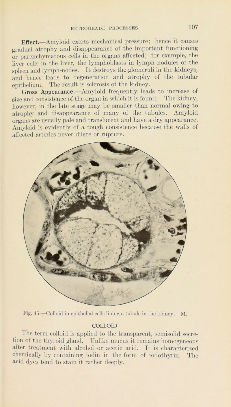 Effect.—Amyloid exerts mechanical pressure; hence it causes gradual atro])hy and disappearance of the important functioning or parenchymatous cells in the organs affected; for example, the liver cells in the liver, the lymphoblasts in lymph nodules of the spleen and lymph-nodes. It destroys the glomeruli in the kidneys, and hence leads to degeneration and atrophy of the tubular epithelium. The result is sclerosis of the kidney. Gross Appearance.—Amyloid frequently leads to increase of size and consistence of the organ in which it is found. The kidney, however, in the late stage may be smaller than normal owing to atrophy and disappearance of many of the tubules. Amyloid organs are usually pale and translucent and have a dry appearance. Amyloid is evidently of a tough consistence because the walls of affectetl arteries never dilate or rupture. Fig. 45.—Colloid in epithelial cells lining a tubule in the kidney. M. COLLOID The term colloid is applied to the transparent, semisolid secre- tion of the thyroid gland. Unlike mucus it remains homogeneous after treatment with alcohol or acetic acid. It is characterized chemically by containing iodin in the form of iodothyrin. The acid dyes tend to stain it rather deeply.