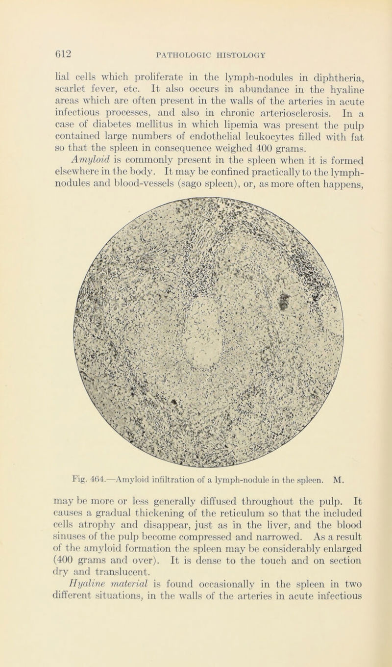 G12 lial cells which iiroliferate in the lymph-nodules in diphtheria, scarlet fever, etc. It also occurs in abundance in the hyaline areas which are often ]:>resent in the walls of the arteries in acute infectious ])rocesses, and also in chronic arteriosclerosis. In a ca.se of diabetes mellitus in which lipemia was ]iresent the pulp contained large numbers of endothelial leukocytes filled with fat so that the spleen in consequence weighed 400 grams. Amyloid is commonly present in the S])leen when it is formed elsewhere in the body. It may be confined practically to the lym])h- nodules and blood-vessels (sago spleen), or, as more often happens. Fig. 4G4.—Amyloid infiltration of a lymph-nodulo in the spleen. M. may be more or le.ss generally diffused throughout the pulp. It causes a gradual thickening of the reticulum so that the included cells atrojihy and disappear, ju.st as in the liver, and the blood sinuses of the pulp liecorne compre.ssed and narrowed. As a result of tlu! amyloid formation the spleen may be considerably enlarg(*d (400 grams and over). It is den.se to the touch and on section dry and translucent. I[y(dine material is found occasionally in the s])leen in two different .situations, in the walls of the articles in acute infectious