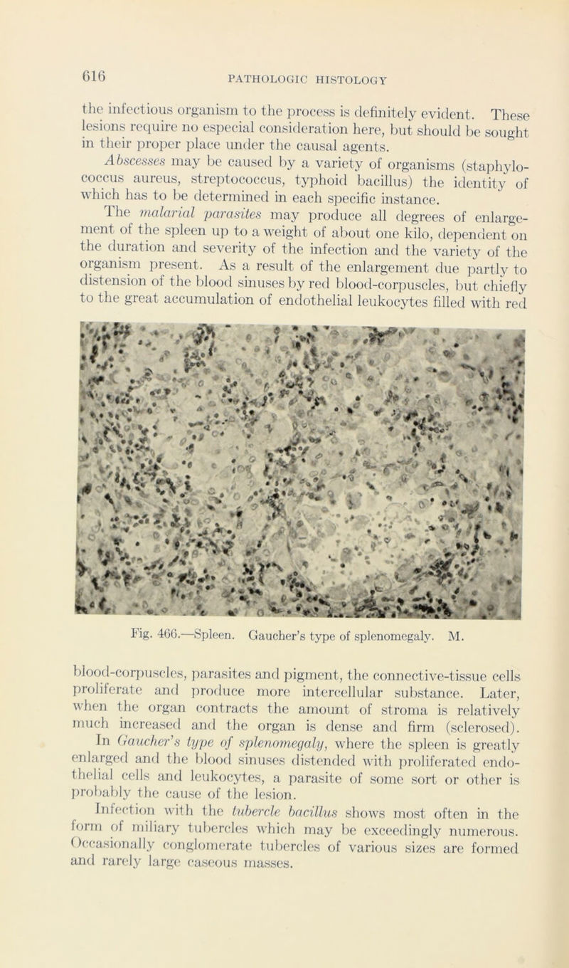61G the intectious organisin to the jiroeess is definitely evident. These lesions reiiuire no especial consideration here, Init should he sought in their i)ro])er place under the causal agents. Abscesses may he caused hy a variety of organisms (staphylo- coccus aureus, streptococcus, typhoid bacillus) the identity of which has to he determined in each specific instance. d he tncdarial parasites may produce all degrees of enlarge- ment of the s])leen u]) to a weight of about one kilo, dependent on the duration and severity of the infection and the variety of the organism ])resent. As a result of the enlargement due partly to distension of the blood sinuses l)y red hlood-corimscles, hut chiefly to the great accumulation of endothelial leukocytes filled with red Fig. 4GG.—Spleen. Gaucher’s type of splenomegaly. M. blood corj)uscles, jiarasitcs and }:>igment, the connective-tissue cells proliferate and jiroduce more intercellular substance. Later, when the organ contracts the amount of stroma is relatively much increased and the organ is dense and firm (sclerosed). In Gaucher's type of splenomegaly, where the siileen is greatly enlarged and the blood sinuses distended with jiroliferated ('ndo- thelial cells and leukocytes, a parasite of some sort or other is probably the cause of the lesion. Infi'ction with the tubercle bacillus shows most often in the form of miliary tulxTcles which may be exceedingly numerous. Occasionally conglomerafc' tubercles of various sizes are formed and rarely large (;aseous masses.