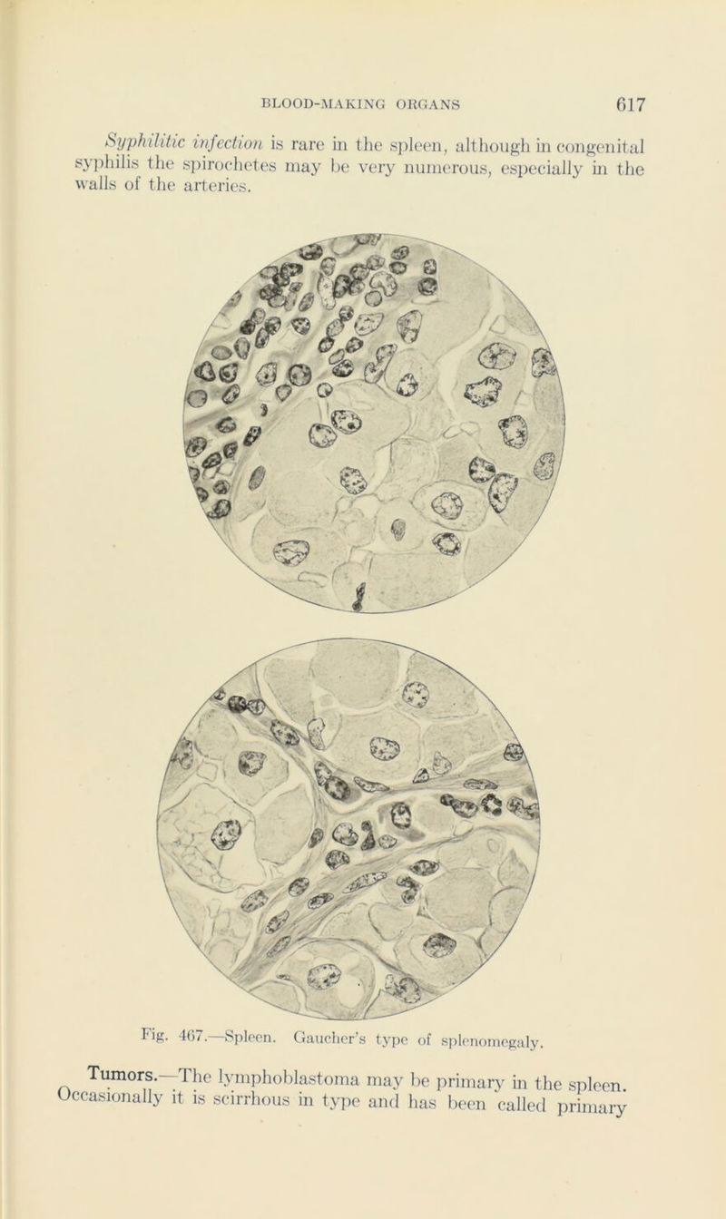 Syphilitic infection is rare in the spleen, although in congenital syjihilis the spirochetes may be very numerous, especially in the walls of the arteries. Fig. 407.—Spleen. Gaucher’s type of splenomegaly. Tumors.—The lympholilastoma may be primary in the spleen. Occasionally it is scirrhous in type and has been called primary