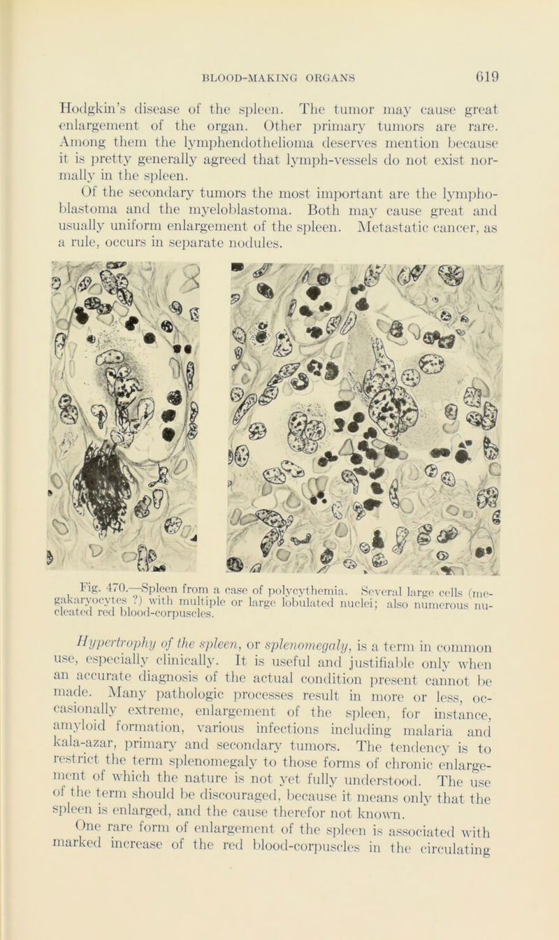 Hodftkin’s disease of the s])leeii. The tumor ma}’ cause ji,reat enlargement of the organ. Other ])rimary tumors are rare. Among them the lymphendothelioma tleserves mention Ijeeause it is })retty generally agreed that lym])h-vessels do not exist nor- mally in the sideeii. Of the secondary tumors the most imj:)oi’tant are the lymj:)ho- hlastoma and the myeloblastoma. Both may cause great and usually uniform enlargement of the spleen. ^Metastatic cancer, as a rule, occurs in separate notlules. Fig. 470.-—Spleen from a ease of ]K)lvcj4hemia. Several large eells (me- gakarycjeytes ?) with multiple or large lobulated nuclei; also numerous nu- cleati'd red bloorl-corpuscles. Hypertrophy of the spleen, or splenomegaly, is a term in common use, especially clinically. It is useful and justifiable onlj' when an accurate diagnosis of the actual condition ])rc.sent cannot be made. Many iiathologic iirocesses result in more or less, oc- casionally extreme, enlargement of the sjtleen, for instance, amyloitl formation, various infections including malaria anti kala-azar, jn-imary and secondary tumors. The tendency is to restrict the term splenomegaly to those forms of chronic milarge- nu'iit of which the nature is not yet fully imder.stood. The use of the term should be discouraged, because it means only that the si)leen is enlarged, and the cause therefor not knonn. One rare form of enlargement of the sideen is as.sociated with marked increase of the red blood-corpuscles in the circulating