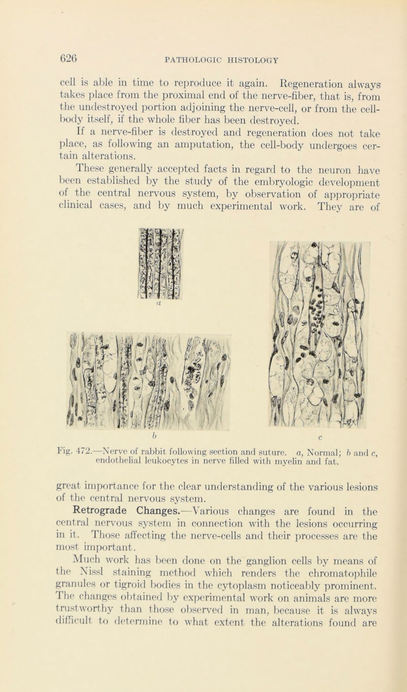 cell is al)le in time to reiiroduce it again. Regeneration always takes ])lace from the proximal end of the nerve-fiber, that is, from the nndestroyed iiortion adjoining the nerve-cell, or from the cell- body itself, if the whole fiber has been destroyed. If a nerve-fiber is destroyed and regeneration does not take })lace, as following an amputation, the cell-body undergoes cer- tain alterations. These generally accejited facts in regard to the neuron have been established by the study of the embryologic development of the central nervous system, by oliservation of appropriate clinical cases, and by much experimental work. They are of Fig. 472.—Nerve of rabbit following section and suture, a, Normal; b and c, endothelial leukocytes in nerve filled with myelin and fat. great importance for the clear understanding of the various lesions of the central nervous system. Retrograde Changes.—Various changes are found in the central nervous system in connection with the lesions occurring in it. Those affecting the nerve-cells and their jtrocesses are the most important. Much work has been done on the ganglion cells by means of the Xi.ssl staining method which renders the chromatophile granules or tigroid Inxlies in the cytoplasm noticeably prominent. 1 he changes obtained by experimental work on animals are more trustworthy than those observed in man, l)ecanse it is always difficult to d(‘termine to what extent the alterations found are