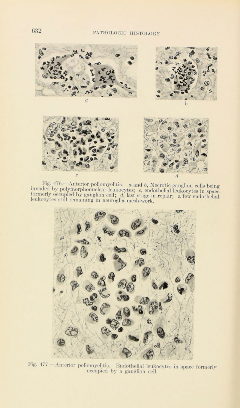PATHOLOCiIC HISTOLOGY *9 * <3SE> k ^ * ' * ^ j •» -•** A i V @ 4 *V^ <» a - ‘S - 'ft- «5T ■? «ft-,«^r,-? 'S', ' • -='^ *>iV I& ^4'^r , ^ v»-~ ■•- -. d I-iS. 4/().—Anterior poliomyelitis, a and h, Necrotic ganglion cells being invaded by polymorphonuclear leukocytes; c, endothelial leukocytes in space formerly occupied by ganglion cell; d, last stage in repair; a few endothehal leukocyte's still remaining m neuroglia mesh-work. Fig. 477.—Anterior poliomyelitis. Endothelial leukocytes in space formerly occiijiied by a ganglion cell.