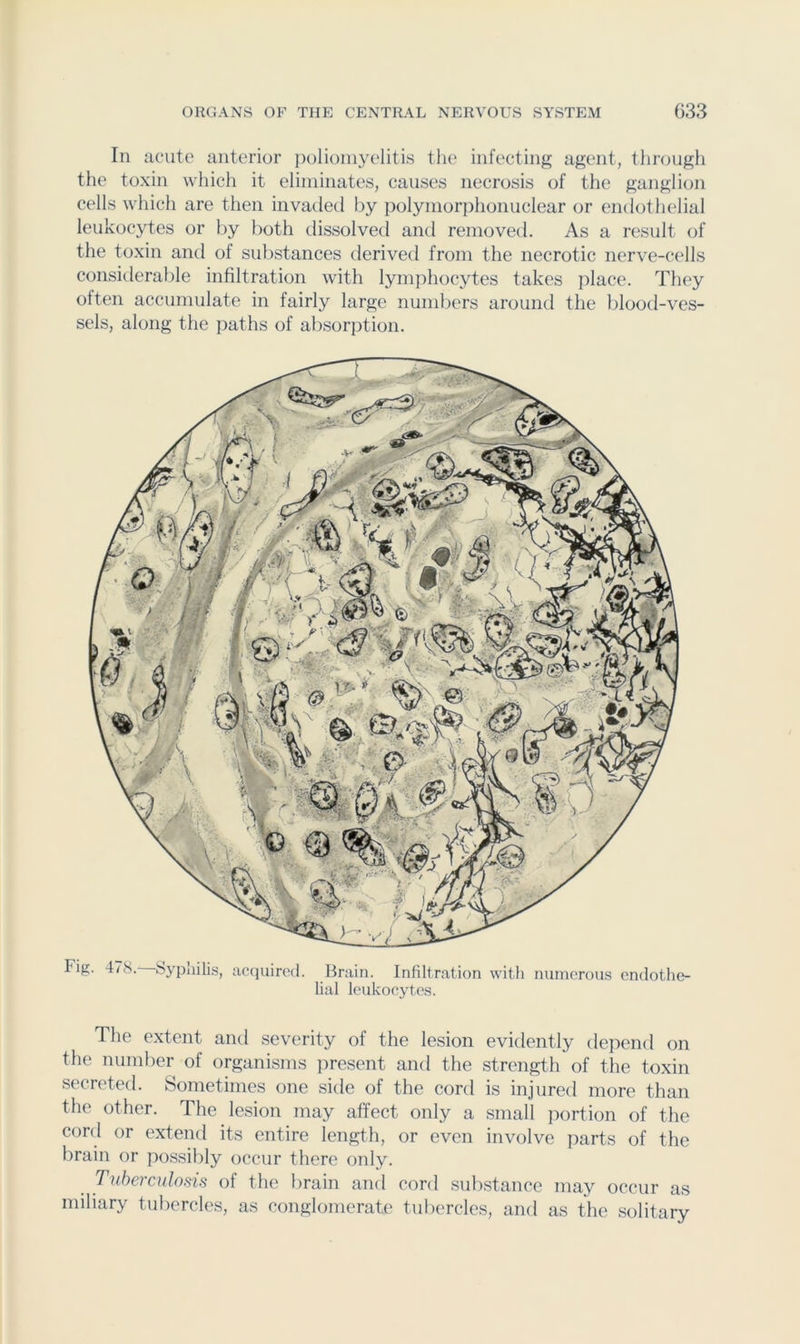 In acute anterior poliomyelitis the infecting agent, through the toxin which it eliminates, causes necrosis of the ganglion cells which are then invaded by polymorphonuclear or endothelial leukocytes or by both dissolved and removed. As a result of the toxin and of substances derived from the necrotic nerve-cells considerable infiltration with lymphocytes takes ])lace. They often accumulate in fairly large numbers around the blood-ves- sels, along the ])aths of absorption. Tig. 478. bypliilis, ac(iuirod. Brain. Infiltration with numcron.s endothe- lial leukocytes. The extent and severity of the lesion evidently depend on the numl)er of organisms present and the strength of the toxin secreted. Sometimes one side of the cord is injured more than the other. The lesion may affect only a small i^ortion of the cord or extend its entire length, or even involve })arts of the brain or possibly occur there only. Tuberculosis of the brain and cord substance may occur as miliary tubercles, as conglomerate tubercles, and as the solitary