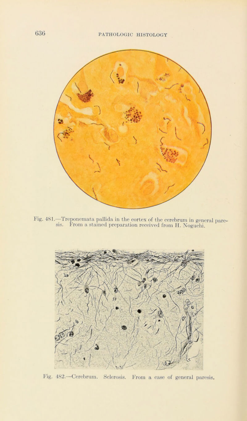 P'ig. 4SL—Treponemata pallida in the cortex of the cerebrum in general pare- sis. From a stained preparation received from PI. Noguchi. Fig. 4S2.—Cen4)rurn. Sclerosis. From a case of general paresis.