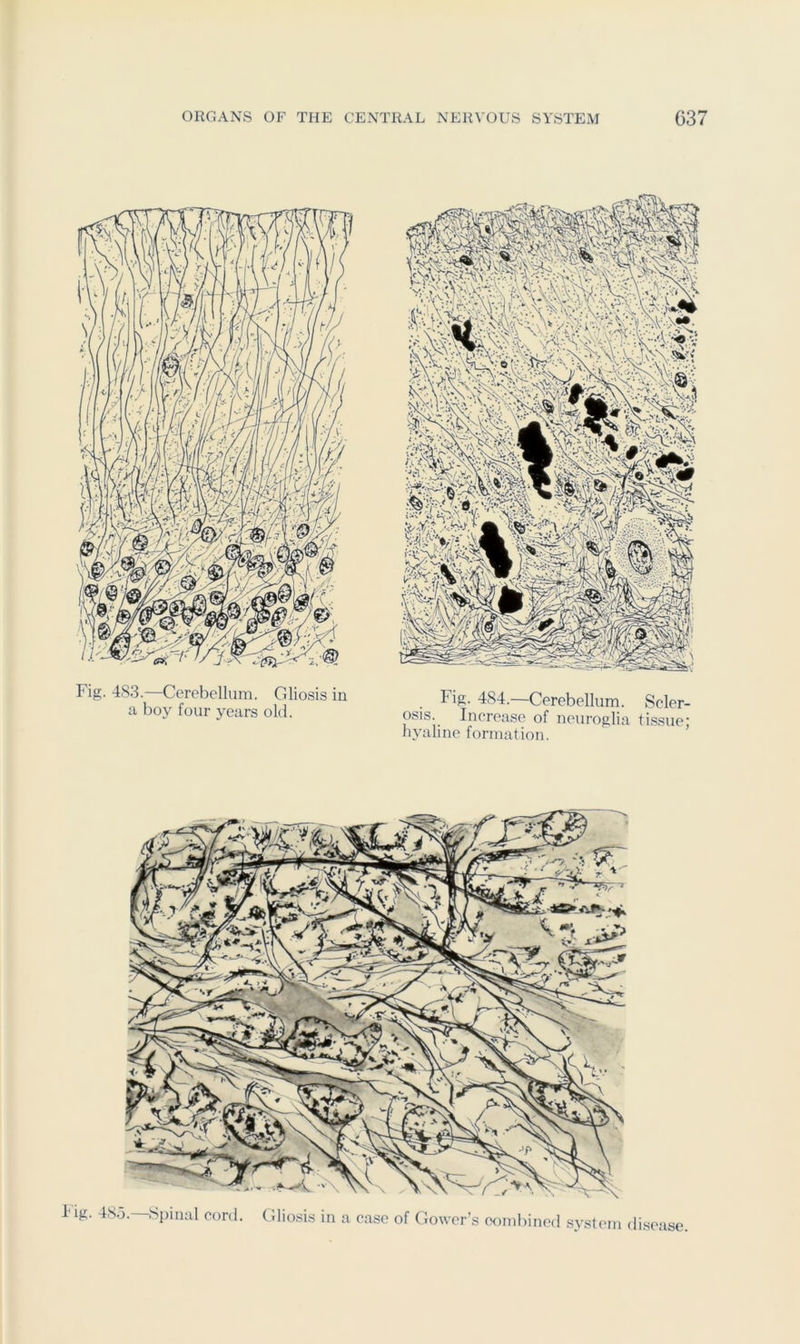 Fig. 483.—Cerebellum. Gliosis in a boy four years old. Fig. 484.—Cerebellum. Scler- osis. Increase of neuroglia ti.ssue- hyaline formation. ’ lig. 48.3.—Sjiinal cord. tdiosis m a ease of Gower’s combined system disease.