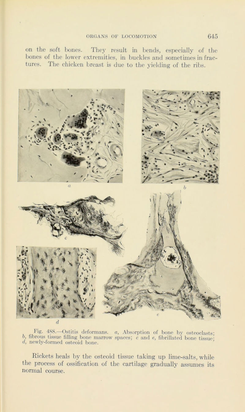 on the soft hones. Tiny result in bends, especially of the hones of the lower extremities, in buckles and sometimes in frac- tures. The chicken breast is due to the yielding of the ribs. d lug. 48S.—()stitis deformans, a, Absorption of lione by osteoclasts' b, fibrous tissue filling bone marrow spaces; c and e, fibrillated bone tissue' d, newly-formed osteoid bone. ’ Rickets heals by the osteoid tissue taking ujt lime-salts, while the process of ossification of the cartilage gradually assumes its normal course.