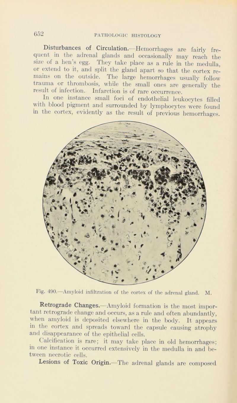 Disturbances of Circulation.— Heiiiorrliciges are fairly fre- quent in the adrenal glands and occasionally may reach the size of a hen’s egg. They take jdace as a rule in the medulla, or extend to it, and split the gland apart so that the cortex re- mains on the outside. The large hemorrhages usually follow tiauma oi thrombosis, while the small ones are generally the result of infection. Infarction is of rare occurrence. In one instance small foci of endothelial leukocytes filled with blood ihgment and surrounded by lyni]ihocytes were found in the cortex, evitlently as the result of previous hemorrhages. Fig. 490. Amyloid infiltration of the cortex of the adrenal gland. M. Retrograde Changes.—Amyloid formation is the most ini]X)r- tant retrograde change and occurs, as a rule and often abundantly, when amyloid is de])osited elsewhere in the body. It appt'ars in the cortex and spreads toward the cajtsule causing atrojthy and disappearance of the epithelial cells. ( alcification is rare; it may take jtlace in old hemorrhages; in one instance it occurred extensively in the medulla in and be- tween lU'crotic ct'lls. Lesions of Toxic Origin.—The adrenal glands are comitosed