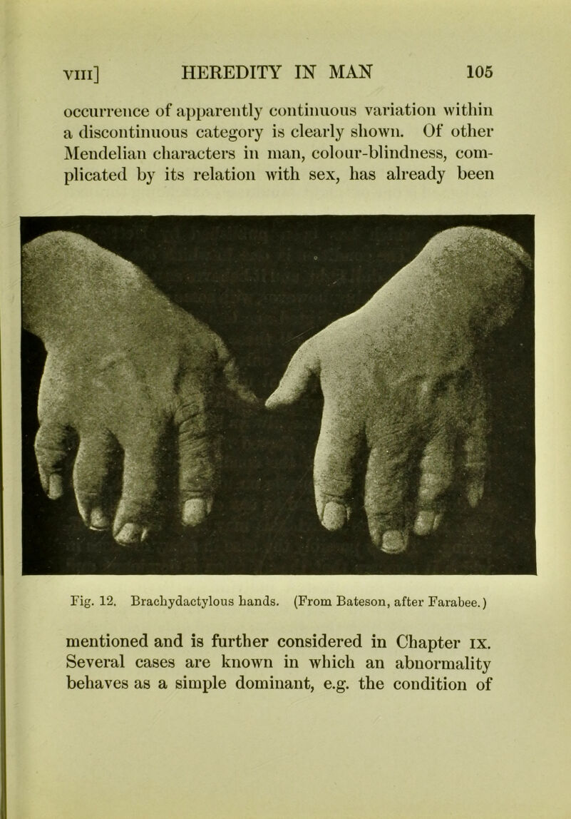 occurrence of apparently continuous variation within a discontinuous category is clearly shown. Of other JMenclelian characters in man, colour-blindness, com- plicated by its relation with sex, has already been Fig. 12. Braclaydactylous bands. (From Bateson, after Farabee.) mentioned and is further considered in Chapter ix. Several cases are known in which an abnormality behaves as a simple dominant, e.g. the condition of