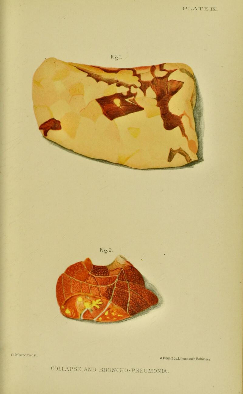 i*ie G. Mai*x,fer;ii A.HnEn X Co,Lithncauslic,Baltimore. COLLAPSE AND BRONCHO-PNEUMONIA. I