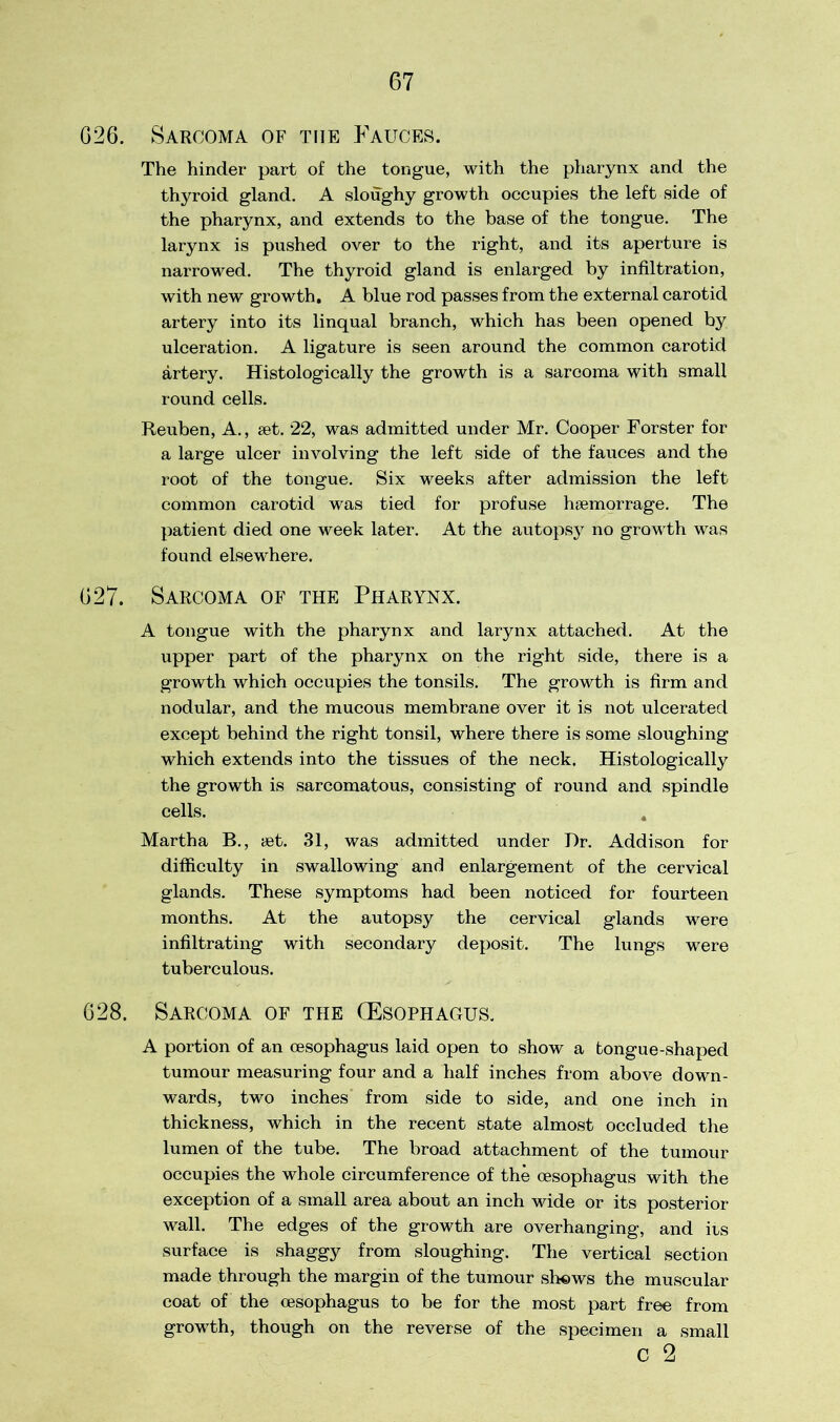 G26. Sarcoma of the Fauces. The hinder part of the tongue, with the pharynx and the thyroid gland. A sloughy growth occupies the left side of the pharynx, and extends to the base of the tongue. The larynx is pushed over to the right, and its aperture is narrowed. The thyroid gland is enlarged by infiltration, with new growth. A blue rod passes from the external carotid artery into its linqual branch, which has been opened by ulceration. A ligature is seen around the common carotid artery. Histologically the growth is a sarcoma with small round cells. Reuben, A., set. 22, was admitted under Mr. Cooper Forster for a large ulcer involving the left side of the fauces and the root of the tongue. Six weeks after admission the left common carotid was tied for profuse hsemorrage. The patient died one week later. At the autopsy no growth was found elsewhere. 627. Sarcoma of the Pharynx. A tongue with the pharynx and larynx attached. At the upper part of the pharynx on the right side, there is a growth which occupies the tonsils. The growth is firm and nodular, and the mucous membrane over it is not ulcerated except behind the right tonsil, where there is some sloughing which extends into the tissues of the neck. Histologically the growth is sarcomatous, consisting of round and spindle cells. Martha B., yet. 31, was admitted under Hr. Addison for difficulty in swallowing and enlargement of the cervical glands. These symptoms had been noticed for fourteen months. At the autopsy the cervical glands were infiltrating with secondary deposit. The lungs were tuberculous. 628. Sarcoma of the (Esophagus. A portion of an oesophagus laid open to show a tongue-shaped tumour measuring four and a half inches from above down- wards, two inches from side to side, and one inch in thickness, which in the recent state almost occluded the lumen of the tube. The broad attachment of the tumour occupies the whole circumference of the oesophagus with the exception of a small area about an inch wide or its posterior wall. The edges of the growth are overhanging, and its surface is shaggy from sloughing. The vertical section made through the margin of the tumour shews the muscular coat of the oesophagus to be for the most part free from growth, though on the reverse of the specimen a small c 2