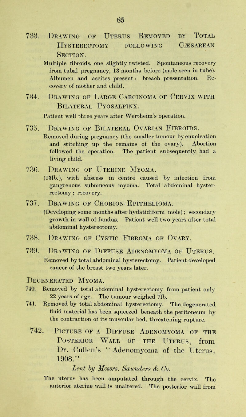 733. Drawing of Uterus Bemoved by Total Hysterectomy following Cjesarean Section. Multiple fibroids, one slightly twisted. Spontaneous recovery from tubal pregnancy, 13 months before (mole seen in tube). Albumen and ascites present: breach presentation. Re- covery of mother and child. 734. Drawing of Large Carcinoma of Cervix with Bilateral Pyosalpinx. Patient well three years after Wertheim’s operation. 735. Drawing of Bilateral Ovarian Fibroids. Removed during pregnancy (the smaller tumour by enucleation and stitching up the remains of the ovary). Abortion followed the operation. The patient subsequently had a living child. 736. Drawing of Uterine Myoma. (131b.), with abscess in centre caused by infection from gangrenous submucous myoma. Total abdominal hyster- rectomy ; recovery. 737. Drawing of Chorion-Epithelioma. (Developing some months after hydatidiform mole); secondary growth in wall of fundus. Patient well two years after total abdominal hysterectomy. 738. Drawing of Cystic Fibroma of Ovary. 739. Drawing of Diffuse Adenomyoma of Uterus. Removed by total abdominal hysterectomy. Patient developed cancer of the breast two years later. Degenerated Myoma. 740. Removed by total abdominal hysterectomy from patient only 22 years of age. The tumour weighed 71b. 741. Removed by total abdominal hysterectomy. The degenerated fluid material has been squeezed beneath the peritoneum by the contraction of its muscular bed, threatening rupture. 742. Picture of a Diffuse Adenomyoma of the Posterior Wall of the Uterus, from Dr. Cullen’s “ Adenomyoma of the Uterus, 1908.” Lent by Messrs. Saunders & Co. The uterus has been amputated through the cervix. The anterior uterine wall is unaltered. The posterior wall from