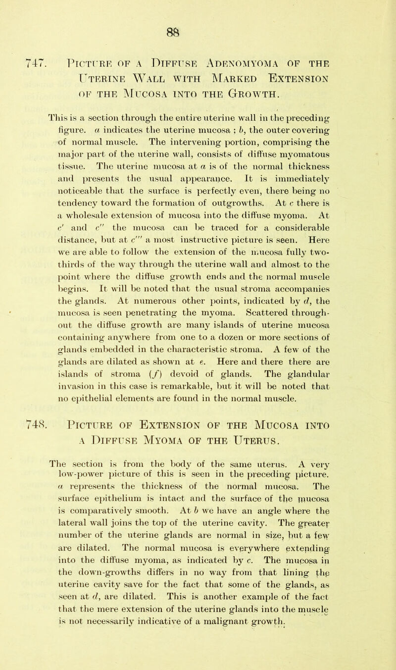 747. Picture of a Diffuse Adenomyoma of the Uterine Wall with Marked Extension of the Mucosa into the Growth. This is a section through the entire uterine wall in the preceding figure, a indicates the uterine mucosa ; b, the outer covering of normal muscle. The intervening portion, comprising the major part of the uterine wall, consists of diffuse myomatous tissue. The uterine mucosa at a is of the normal thickness and presents the usual appearance. It is immediately noticeable that the surface is perfectly even, there being no tendency toward the formation of outgrowths. At c there is a wholesale extension of mucosa into the diffuse myoma. At c’ and c the mucosa can be traced for a considerable distance, but at c' a most instructive picture is seen. Here we are able to follow the extension of the mucosa fully two- thirds of the way through the uterine wall and almost to the point where the diffuse growth ends and the normal muscle begins. It will be noted that the usual stroma accompanies the glands. At numerous other points, indicated by d, the mucosa is seen penetrating the myoma. Scattered through- out the diffuse growth are many islands of uterine mucosa containing anywhere from one to a dozen or more sections of glands embedded in the characteristic stroma. A few of the glands are dilated as shown at e. Here and there there are islands of stroma (/) devoid of glands. The glandular invasion in this case is remarkable, but it will be noted that no epithelial elements are found in the normal muscle. 748. Picture of Extension of the Mucosa into a Diffuse Myoma of the Uterus. The section is from the body of the same uterus. A very low-power picture of this is seen in the preceding picture. a represents the thickness of the normal mucosa. The surface epithelium is intact and the surface of tjie mucosa is comparatively smooth. At b we have an angle where the lateral wall joins the top of the uterine cavity. The greater number of the uterine glands are normal in size, jmt a few are dilated. The normal mucosa is everywhere pxtepding into the diffuse myoma, as indicated by c. The muposa ip the down-growths differs in no way from that lining thp uterine cavity save for the fact that some of the glands, as seen at d, are dilated. This is another example of the fact that the mere extension of the uterine glands into the muscle is not necessarily indicative of a malignant growth.