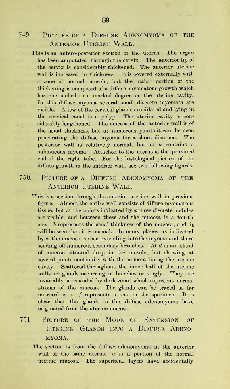 749 Picture oe a Diffuse Adenomyoma of the Anterior Uterine Wall. This is an antero-posterior section of the uterus. The organ has been amputated through the cervix. The anterior lip of the cervix is considerably thickened. The anterior uterine wall is increased in thickness. It is covered externally with a zone of normal muscle, but the major portion of the thickening is composed of a diffuse myomatous growth which has encroached to a marked degree on the uterine cavity. In this diffuse myoma several small discrete myomata are' visible. A few of the cervical glands are dilated and lying ini the cervical canal is a polyp. The uterine cavity is con- siderably lengthened. The mucosa of the anterior wall is of the usual thickness, but at numerous points it can be seen penetrating the diffuse myoma for a short distance. The posterior wall is relatively normal, but at a contains a submucous myoma. Attached to the uterus is the proximal end of the right tube. For the histological picture of the diffuse growth in the anterior wall, see two following figures. 750. Picture of a Diffuse Adenomyoma of the Anterior Uterine Wall. This is a section through the anterior uterine wall in previous figure. Almost the entire wall consists of diffuse myomatous tissue, but at the points indicated by a three discrete nodules are visible, and between these and the mucosa is a fourth one. b represents the usual thickness of the mucosa, and it will be seen that it is normal. In many places, as indicated by c, the mucosa is seen extending into the myoma and there sending off numerous secondary branches. At d is an island of mucosa situated deep in the muscle, but showing at several points continuity with the mucosa lining the uterine cavity. Scattered throughout the inner half of the uterine walls are glands occurring in bunches or singly. They are invariably surrounded by dark zones which represent normal stroma of the mucosa. The glands can be traced as far outward as e. f represents a tear in the specimen. It is clear that the glands in this diffuse adenomyoma have originated from the uterine mucosa. 751 Picture of the Mode of Extension of Uterine Glands into a Diffuse Adeno- myoma. The section is from the diffuse adenomyoma in the anterior wall of the same uterus, a is a portion of the normal uterine mucosa. The superficial layers have accidentally