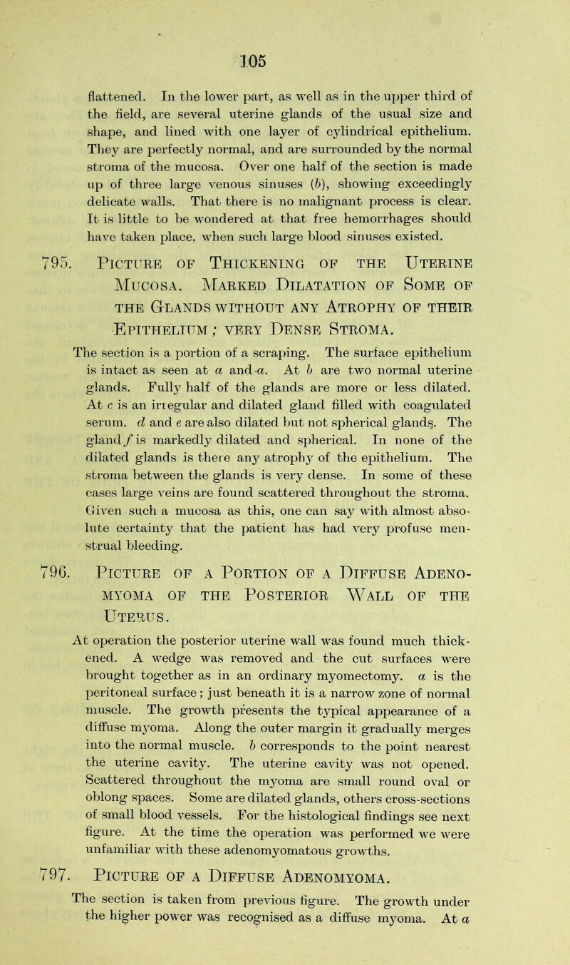 flattened. In the lower part, as well as in the upper third of the field, are several uterine glands of the usual size and shape, and lined with one layer of cylindrical epithelium. They are perfectly normal, and are surrounded by the normal stroma of the mucosa. Over one half of the section is made up of three large venous sinuses (&), showing exceedingly delicate walls. That there is no malignant process is clear. It is little to be wondered at that free hemorrhages should have taken place, when such large blood sinuses existed. 795. Picture of Thickening of the Uterine Mucosa. Marked Dilatation of Some of the Glands without any Atrophy of their Epithelium; very Dense Stroma. The section is a portion of a scraping. The surface epithelium is intact as seen at a and -a. At b are two normal uterine glands. Fully half of the glands are more or less dilated. At c is an irregular and dilated gland filled with coagulated serum, d and e are also dilated but not spherical gland§. The gland / is markedly dilated and spherical. In none of the dilated glands is there any atrophy of the epithelium. The stroma between the glands is very dense. In some of these cases large veins are found scattered throughout the stroma. Given such a mucosa as this, one can say with almost abso- lute certainty that the patient has had very profuse men- strual bleeding. 796. Picture of a Portion of a Diffuse Adeno- MYOMA OF THE POSTERIOR WALL OF THE Uterus. At operation the posterior uterine wall was found much thick- ened. A wedge was removed and the cut surfaces were brought together as in an ordinary myomectomy, a is the peritoneal surface; just beneath it is a narrow zone of normal muscle. The growth presents the typical appearance of a diffuse myoma. Along the outer margin it gradually merges into the normal muscle, b corresponds to the point nearest the uterine cavity. The uterine cavity was not opened. Scattered throughout the myoma are small round oval or oblong spaces. Some are dilated glands, others cross-sections of small blood vessels. For the histological findings see next figure. At the time the operation was performed we were unfamiliar with these adenomyomatous growths. 797. Picture of a Diffuse Adenomyoma. The section is taken from previous figure. The growth under the higher power was recognised as a diffuse myoma. At a