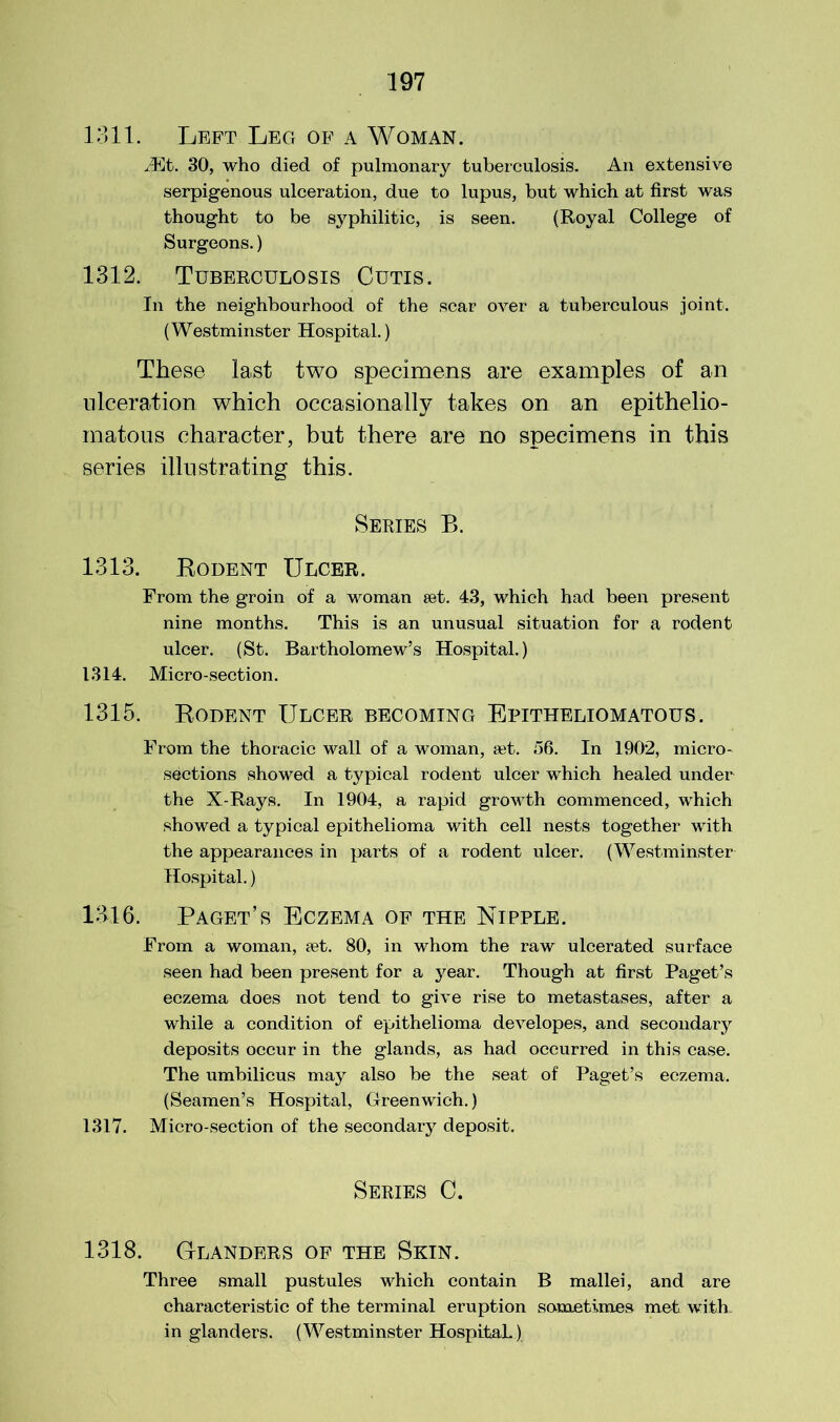 1311. Left Leg of a Woman. iEt. 30, who died of pulmonary tuberculosis. An extensive serpigenous ulceration, due to lupus, but which at first was thought to be syphilitic, is seen. (Royal College of Surgeons.) 1312. Tuberculosis Cutis. In the neighbourhood of the scar over a tuberculous joint. (Westminster Hospital.) These last two specimens are examples of an ulceration which occasionally takes on an epithelio- matous character, but there are no specimens in this series illustrating this. Series B. 1313. Bodent Ulcer. From the groin of a woman set. 43, which had been present nine months. This is an unusual situation for a rodent ulcer. (St. Bartholomew’s Hospital.) 1314. Micro-section. 1315. Bodent Ulcer becoming Epitheliomatous. From the thoracic wall of a woman, set. 56. In 1902, micro - sections showed a typical rodent ulcer which healed under the X-Rays. In 1904, a rapid growth commenced, which showed a typical epithelioma with cell nests together with the appearances in parts of a rodent ulcer. (Westminster Hospital.) 1316. Paget’s Eczema of the Nipple. From a woman, ?et. 80, in whom the raw ulcerated surface seen had been present for a year. Though at first Paget’s eczema does not tend to give rise to metastases, after a while a condition of epithelioma developes, and secondary deposits occur in the glands, as had occurred in this case. The umbilicus may also be the seat of Paget’s eczema. (Seamen’s Hospital, Greenwich.) 1317. Micro-section of the secondary deposit. Series C. 1318. Glanders of the Skin. Three small pustules which contain B mallei, and are characteristic of the terminal eruption sometimes met with- in glanders. (Westminster Hospital.)