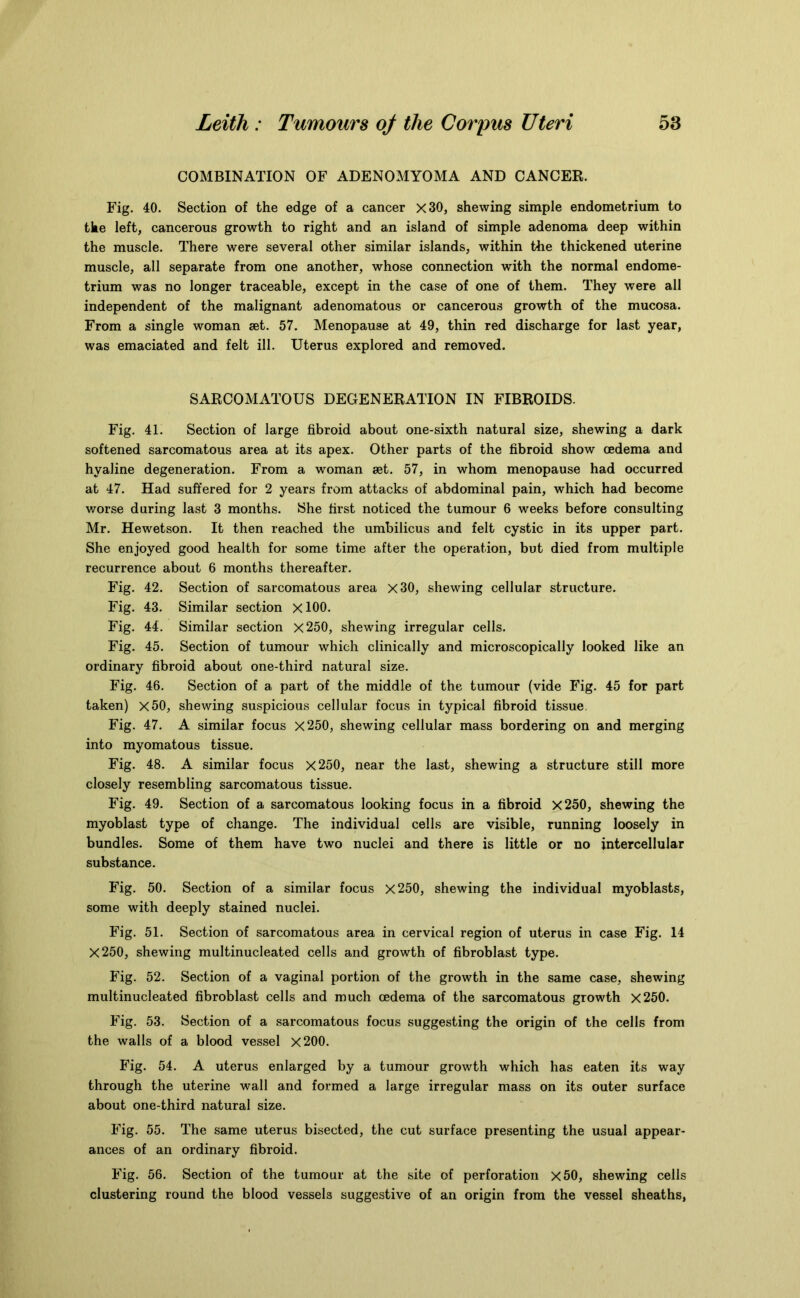 COMBINATION OF ADENOMYOMA AND CANCER. Fig. 40. Section of the edge of a cancer X30, shewing simple endometrium to the left, cancerous growth to right and an island of simple adenoma deep within the muscle. There were several other similar islands, within the thickened uterine muscle, all separate from one another, whose connection with the normal endome- trium was no longer traceable, except in the case of one of them. They were all independent of the malignant adenomatous or cancerous growth of the mucosa. From a single woman set. 57. Menopause at 49, thin red discharge for last year, was emaciated and felt ill. Uterus explored and removed. SARCOMATOUS DEGENERATION IN FIBROIDS. Fig. 41. Section of large fibroid about one-sixth natural size, shewing a dark softened sarcomatous area at its apex. Other parts of the fibroid show oedema and hyaline degeneration. From a woman set. 57, in whom menopause had occurred at 47. Had suffered for 2 years from attacks of abdominal pain, which had become worse during last 3 months. She first noticed the tumour 6 weeks before consulting Mr. Hewetson. It then reached the umbilicus and felt cystic in its upper part. She enjoyed good health for some time after the operation, but died from multiple recurrence about 6 months thereafter. Fig. 42. Section of sarcomatous area X30, shewing cellular structure. Fig. 43. Similar section XlOO. Fig. 44. Similar section X250, shewing irregular cells. Fig. 45. Section of tumour which clinically and microscopically looked like an ordinary fibroid about one-third natural size. Fig. 46. Section of a part of the middle of the tumour (vide Fig. 45 for part taken) X50, shewing suspicious cellular focus in typical fibroid tissue. Fig. 47. A similar focus X250, shewing cellular mass bordering on and merging into myomatous tissue. Fig. 48. A similar focus X250, near the last, shewing a structure still more closely resembling sarcomatous tissue. Fig. 49. Section of a sarcomatous looking focus in a fibroid X250, shewing the myoblast type of change. The individual cells are visible, running loosely in bundles. Some of them have two nuclei and there is little or no intercellular substance. Fig. 50. Section of a similar focus X250, shewing the individual myoblasts, some with deeply stained nuclei. Fig. 51. Section of sarcomatous area in cervical region of uterus in case Fig. 14 X250, shewing multinucleated cells and growth of fibroblast type. Fig. 52. Section of a vaginal portion of the growth in the same case, shewing multinucleated fibroblast cells and much oedema of the sarcomatous growth X250. Fig. 53. Section of a sarcomatous focus suggesting the origin of the cells from the walls of a blood vessel X200. Fig. 54. A uterus enlarged by a tumour growth which has eaten its way through the uterine wall and formed a large irregular mass on its outer surface about one-third natural size. Fig. 55. The same uterus bisected, the cut surface presenting the usual appear- ances of an ordinary fibroid. Fig. 56. Section of the tumour at the site of perforation X50, shewing cells clustering round the blood vessels suggestive of an origin from the vessel sheaths,