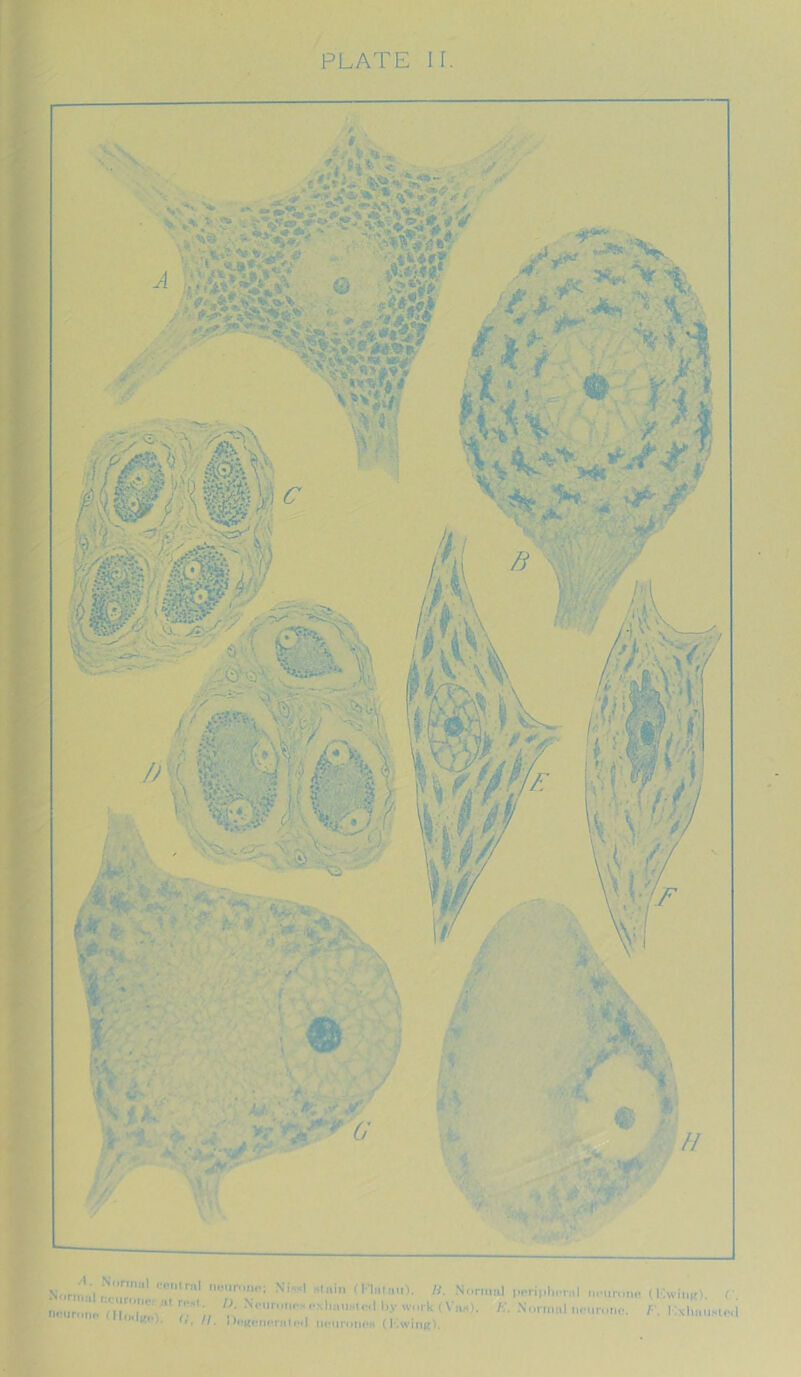 PLATE If. iftr.nn'l rN,,nmi1 contrnl Nlssl stain (Klittn.it>. H. Normal peri,.horn neuroim V '' T' 'K N,-Urt«10!*',4«''slcil by work (Vus). E. Normal neuror K,‘‘ E. I bacon oral ml neurom (Ewing). (Ewing). (’. /•'. Exhausted