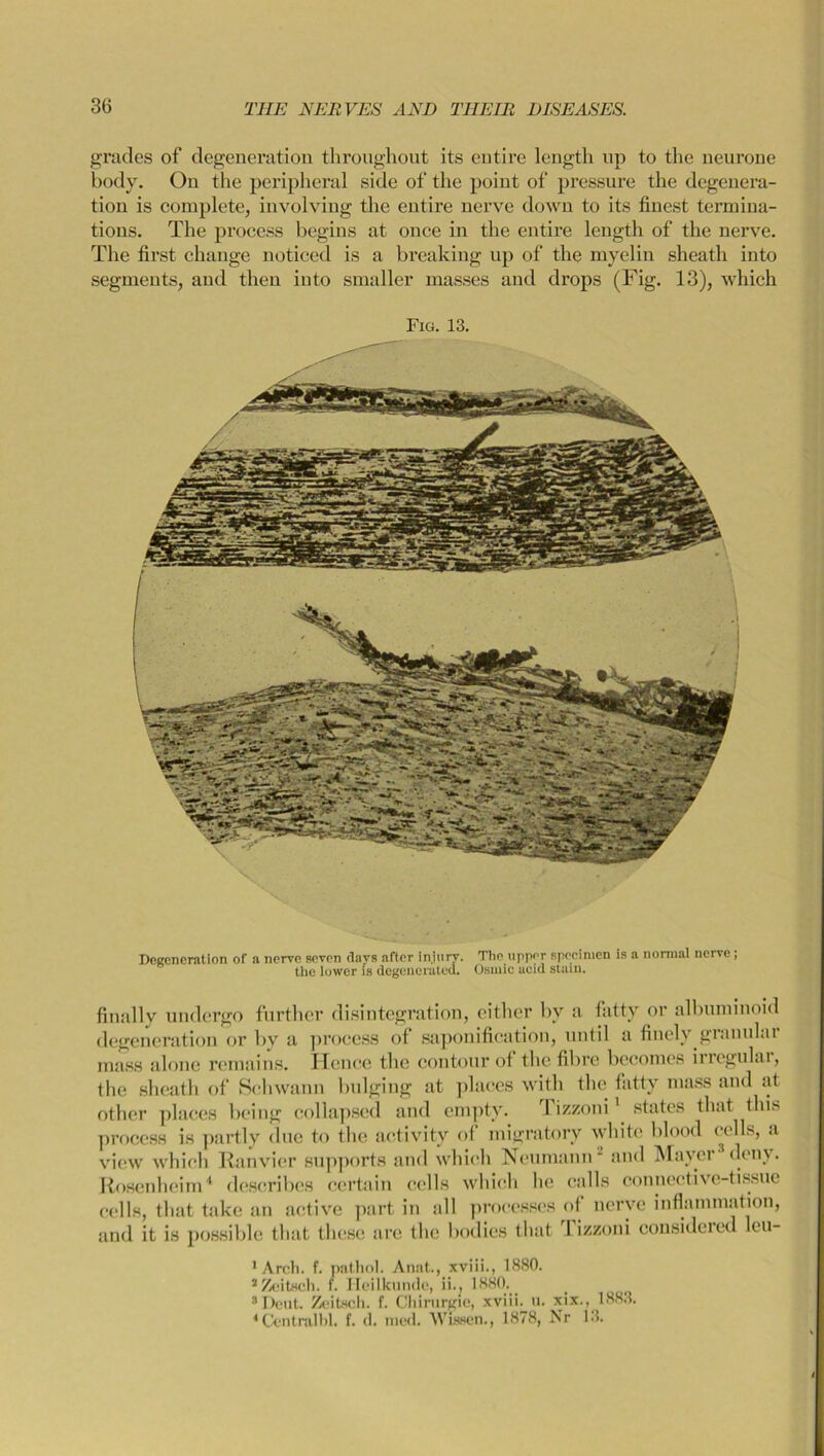 grades of degeneration throughout its entire length up to the neurone body. On the peripheral side of the point of pressure the degenera- tion is complete, involving the entire nerve down to its finest termina- tions. The process begins at once in the entire length of the nerve. The first change noticed is a breaking up of the myelin sheath into segments, and then into smaller masses and drops (Fig. 13), which Fig. 13. neceneration of a nerve seven (lays after injury. The upper specimen is a normal nerve; the lower is degenerated. Osiuic acid stain. finally undergo further disintegration, either by a fatty or albuminoid degeneration or by a process of saponification, until a finely gianulai mass alone remains. Hence the contour of the fibre becomes ii icgulai, the sheath of Schwann bulging at places with the fatty mass and at other places being collapsed and empty. I izzoni1 states that this process is partly due to the activity of migratory white blood c ells, a view which Ranvier supports and which Neumann* and Mayer deny. Rosenheim4 describes certain cells which he calls connective-tissue cells, that take an active part in all processes of nerve inflammation, and it is possible that these are the bodies that 1 izzoni consideied leu- 1 Arcli. f. pathol. Annt., xviii., 1880. 2Zeitsch. f. Heilkunde, ii., 1880. aDent. Zeitsch. f. Chirurgie, xviii. u. xix., 1883.