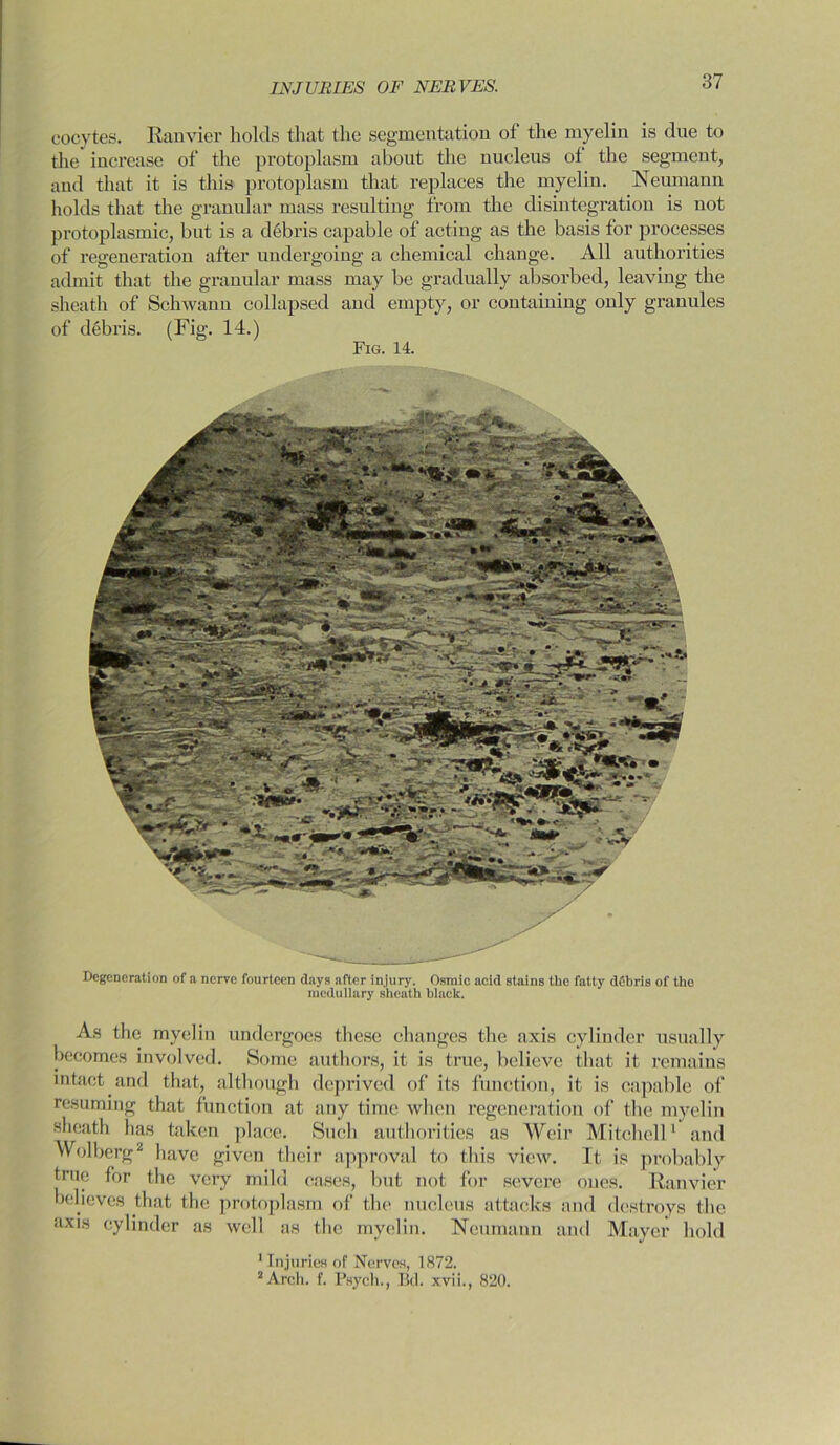 cocytes. Ranvier holds that the segmentation of the myelin is due to the increase of the protoplasm about the nucleus of the segment, and that it is this protoplasm that replaces the myeliu. Neumann holds that the granular mass resulting from the disintegration is not protoplasmic, but is a debris capable of acting as the basis for processes of regeneration after undergoing a chemical change. All authorities admit that the granular mass may be gradually absorbed, leaving the sheath of Schwann collapsed and empty, or containing only granules of debris. (Fig. 14.) Fig. 14. Degeneration of a nerve fourteen days after injury. Osraic acid stains the fatty debris of the medullary sheath black. As the myelin undergoes these changes the axis cylinder usually becomes involved. Some authors, it is true, believe that it remains intact and that, although deprived of its function, it is capable of resuming that function at any time when regeneration of the myelin sheath has taken place. Such authorities as Weir Mitchell1 and Wolberg2 have given their approval to this view. It is probably true for the very mild cases, but not for severe ones. Ranvier believes that the protoplasm of the nucleus attacks and destroys the axis cylinder as well as the myelin. Neumann and Mayer hold 1 Injuries of Nerves, 1872. 2 Arch. f. Psych., Bel. xvii., 820.